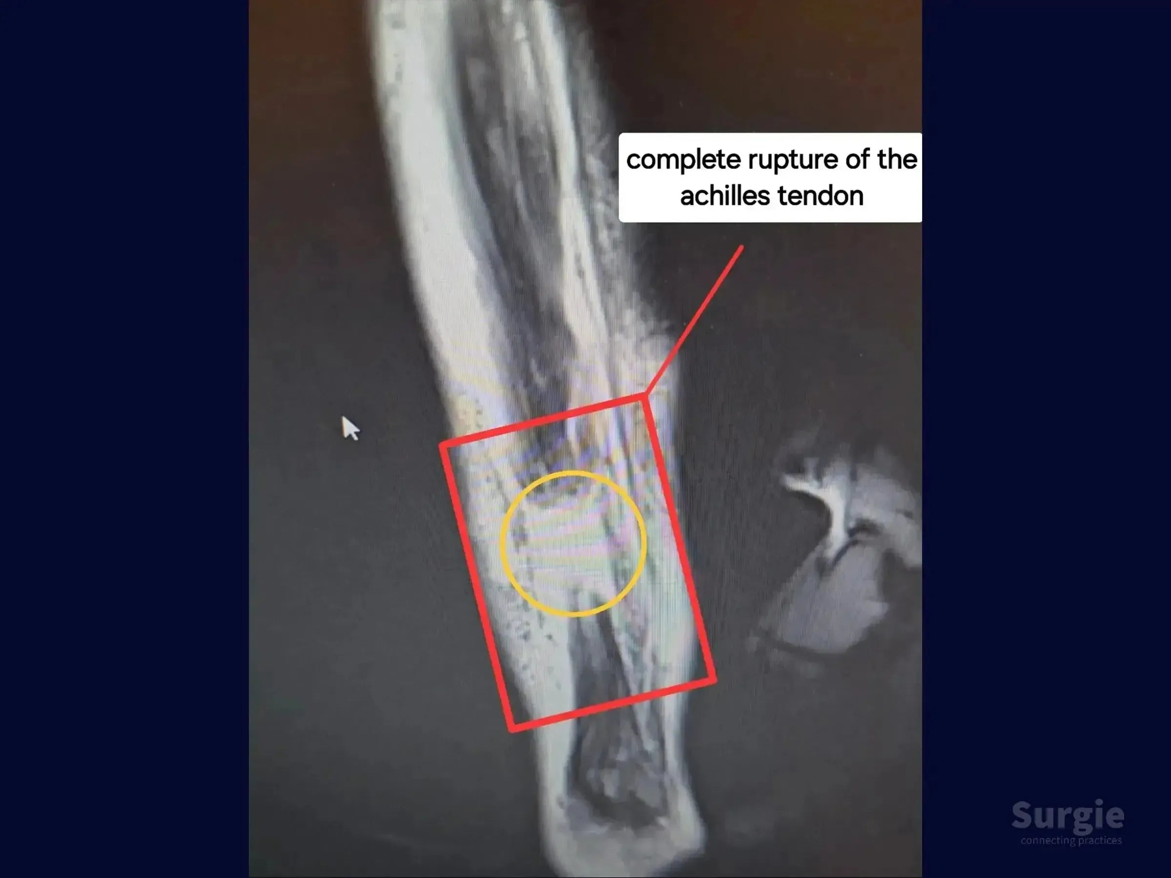 MRI scan showing a complete Achilles tendon rupture highlighted with a red box and yellow circle for surgical planning.