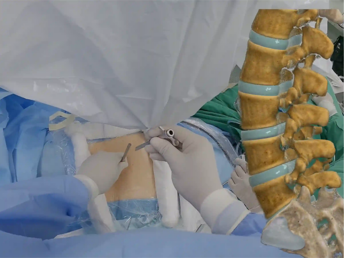 Endoscopic Lumbar Discectomy for Left L4-L5 Disc Herniation