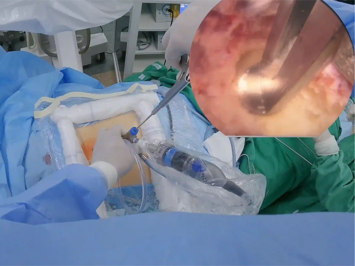 Endoscopic Lumbar Discectomy for Left L4-L5 Disc Herniation