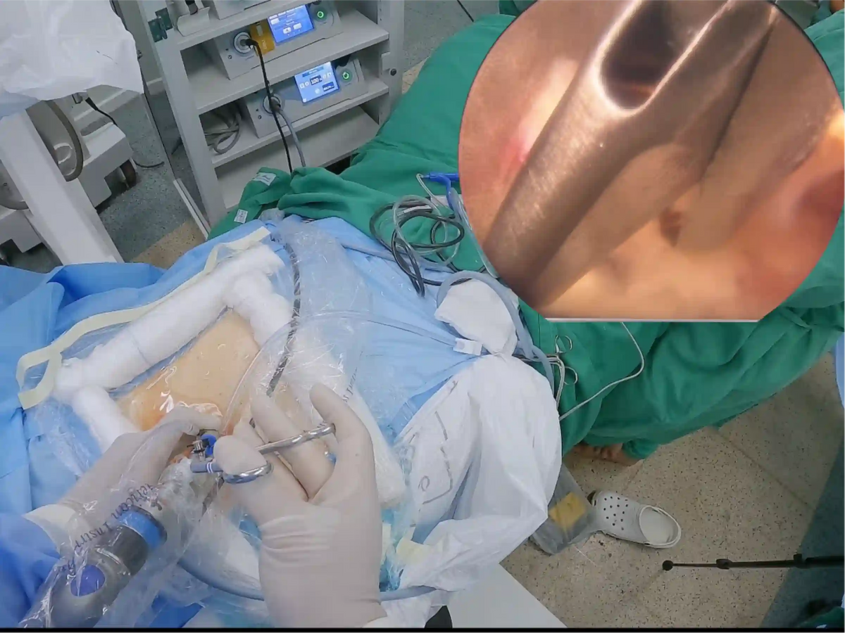 Endoscopic Lumbar Discectomy for Left L4-L5 Disc Herniation