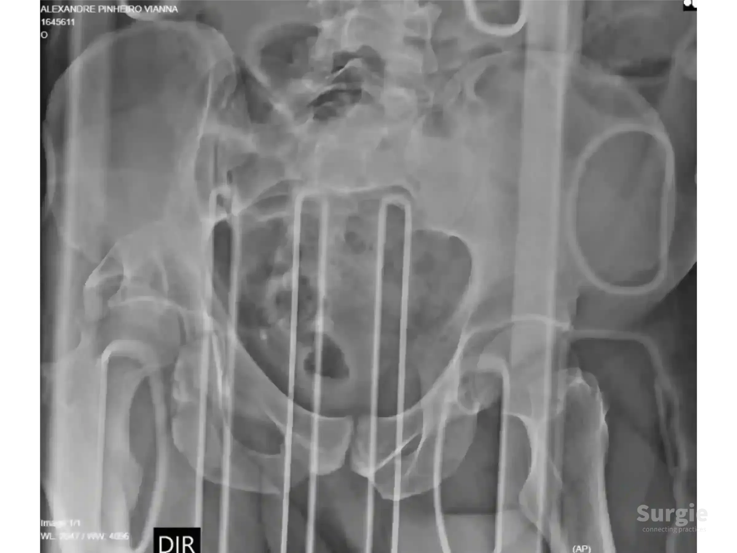 AP pelvic X-ray showing a complex acetabular fracture with posterior wall displacement and articular impaction.