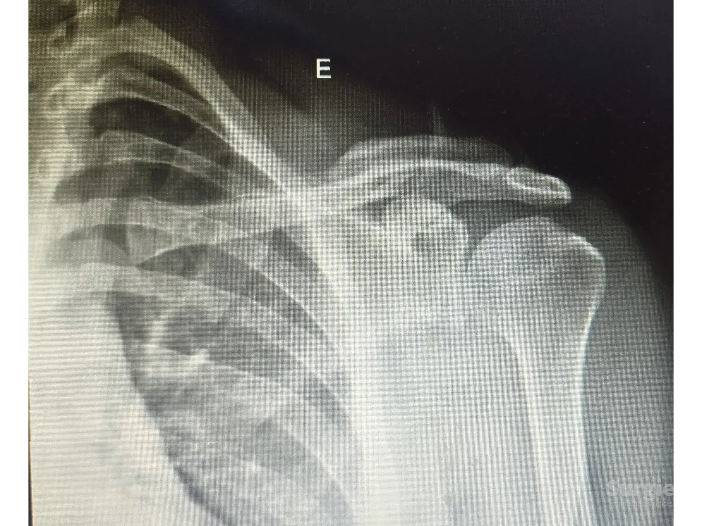 X-ray showing a displaced mid-shaft clavicle fracture with bone overlap and shortening.