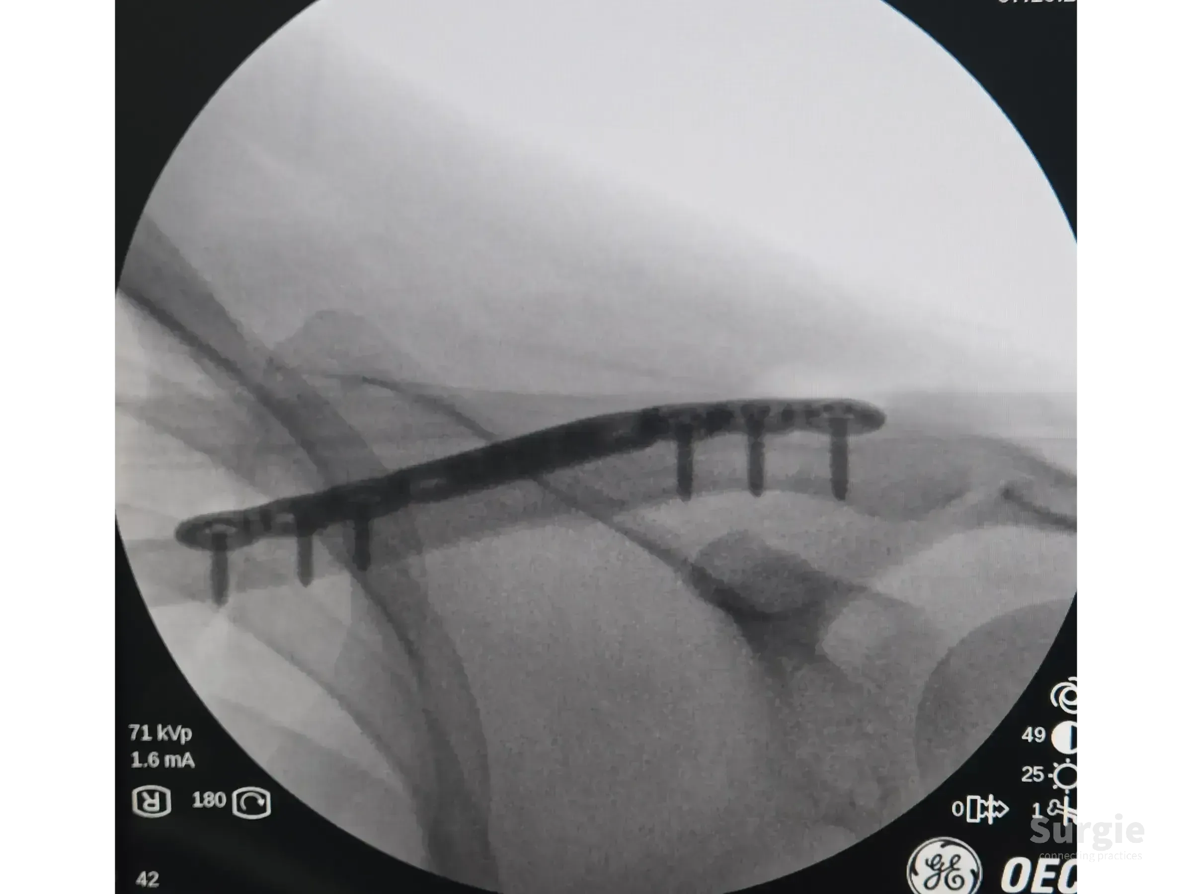Fluoroscopic view of a clavicle fracture fixed with an anatomic metal plate and multiple cortical screws.