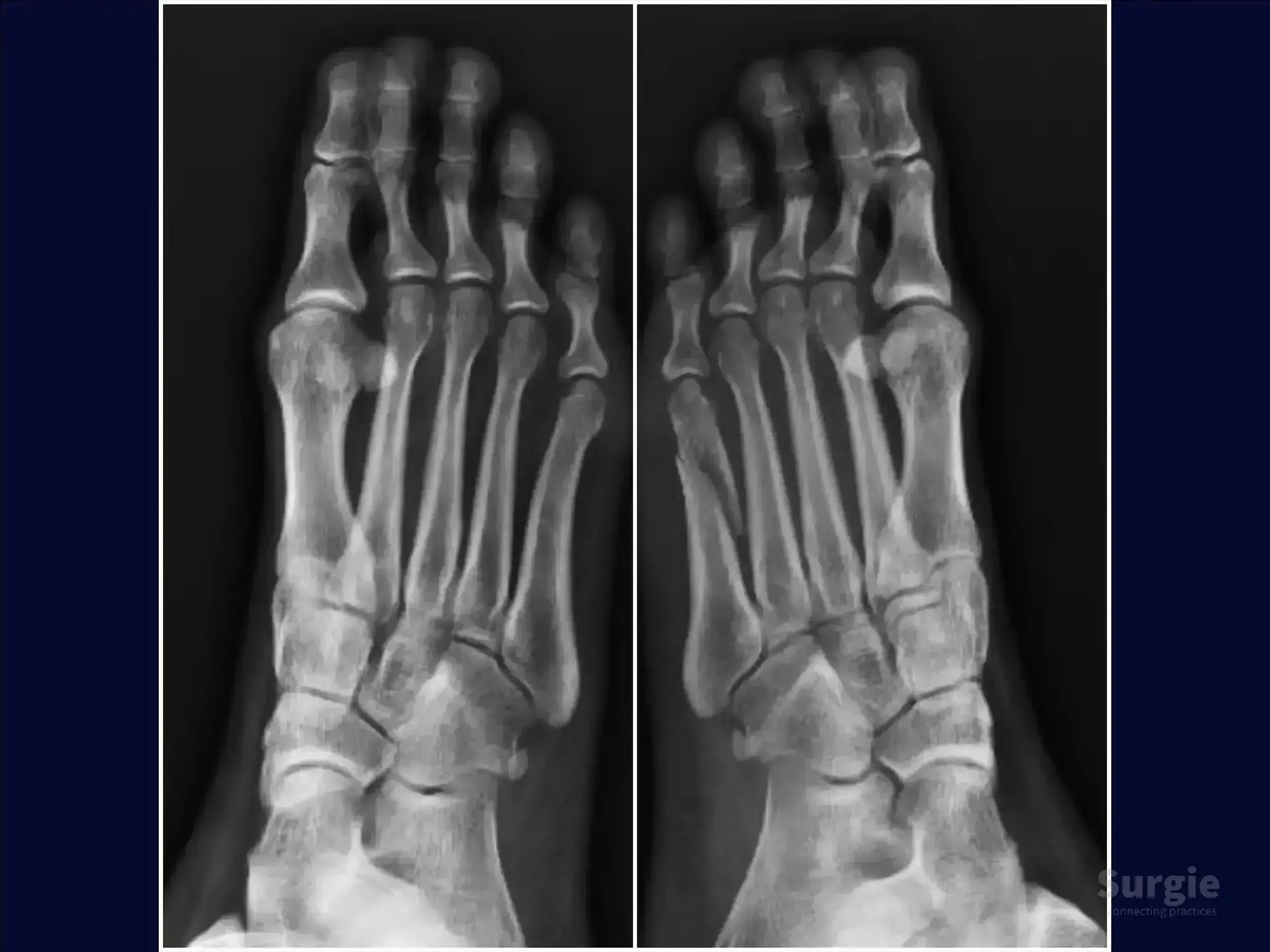 X-ray showing a displaced fracture of the fifth metatarsal bone in the foot, displayed in grayscale.