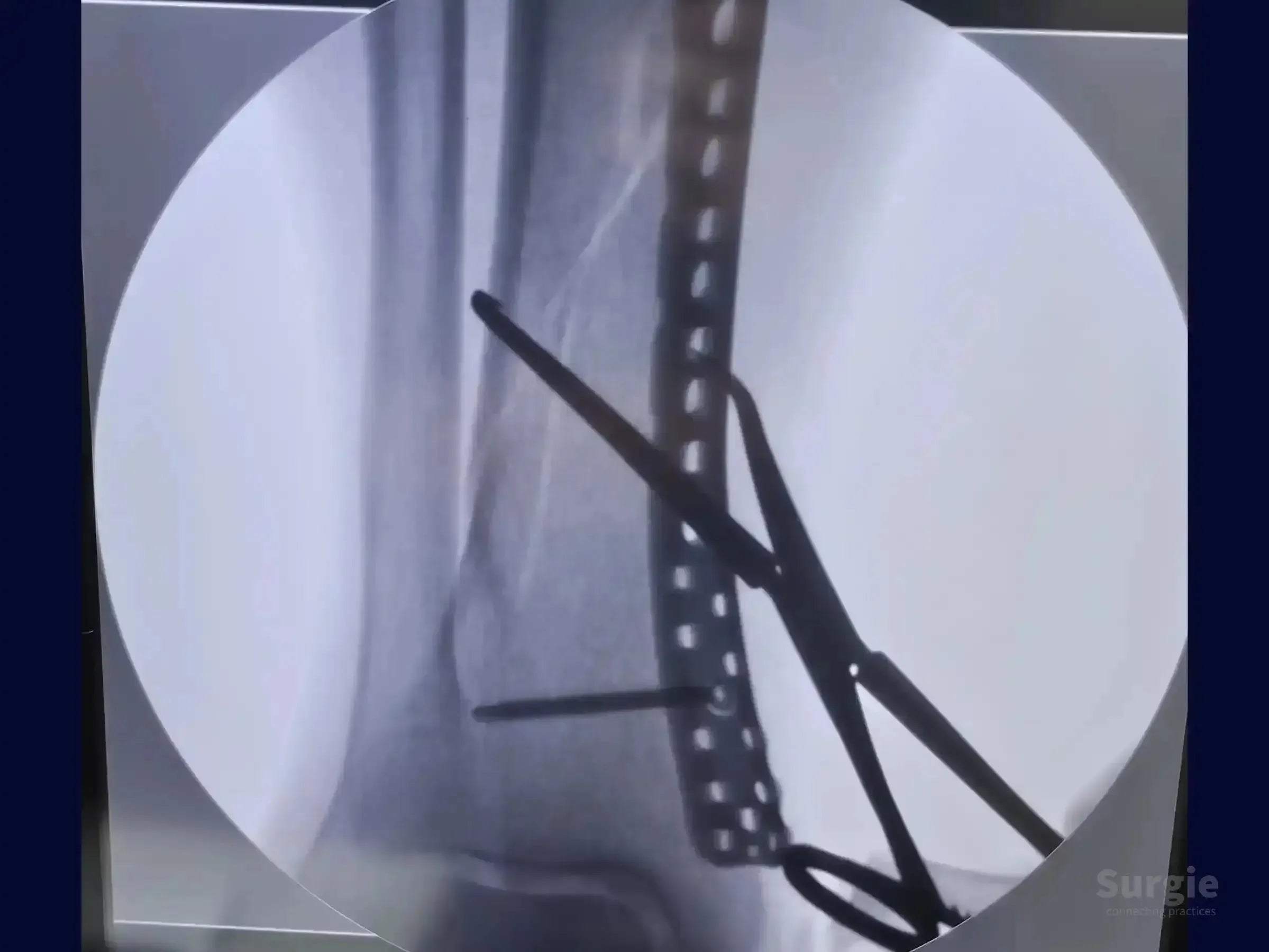 Fluoroscopic X-ray showing a distal tibia fracture stabilized with a metal locked plate and percutaneous reduction clamp.