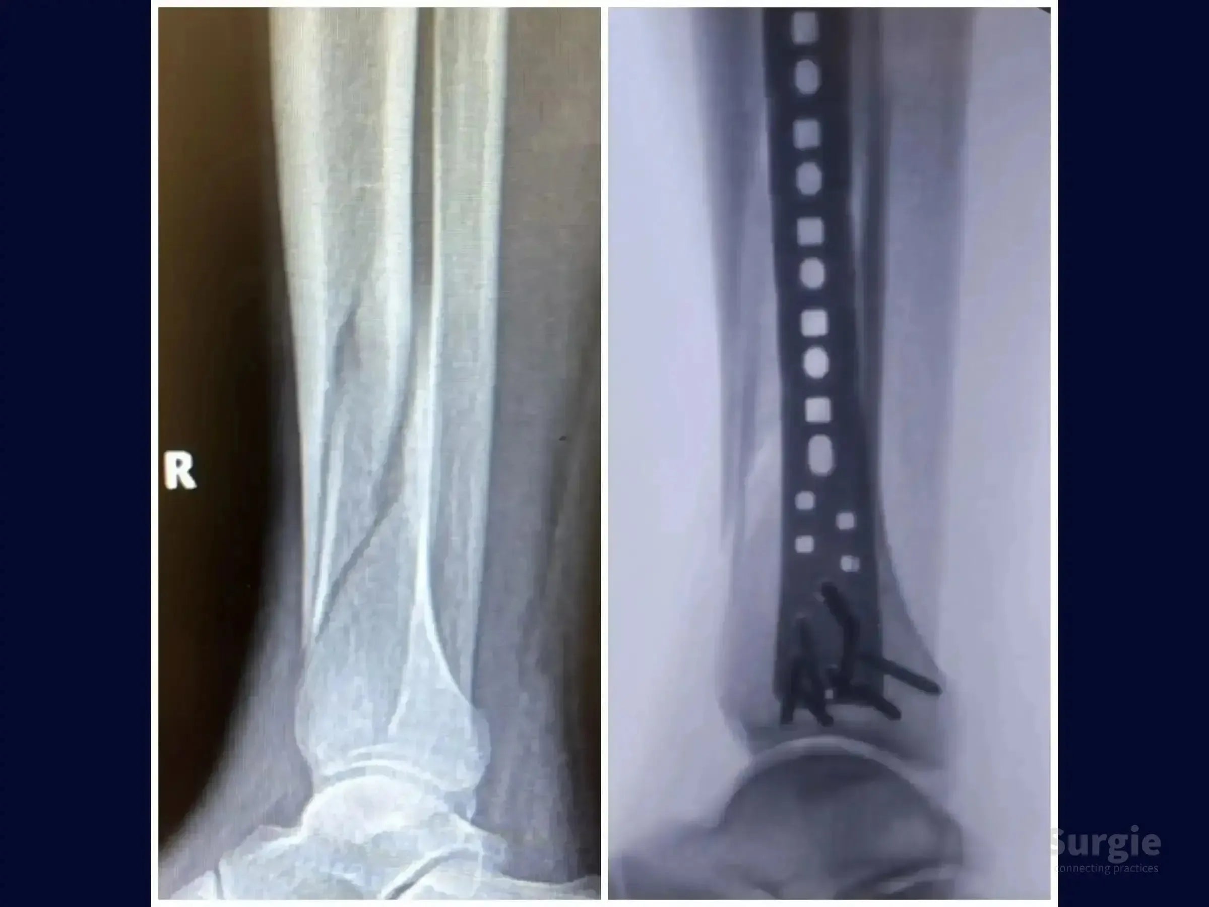 X-ray showing a distal tibia fracture before and after fixation with a metallic locked plate and screws.