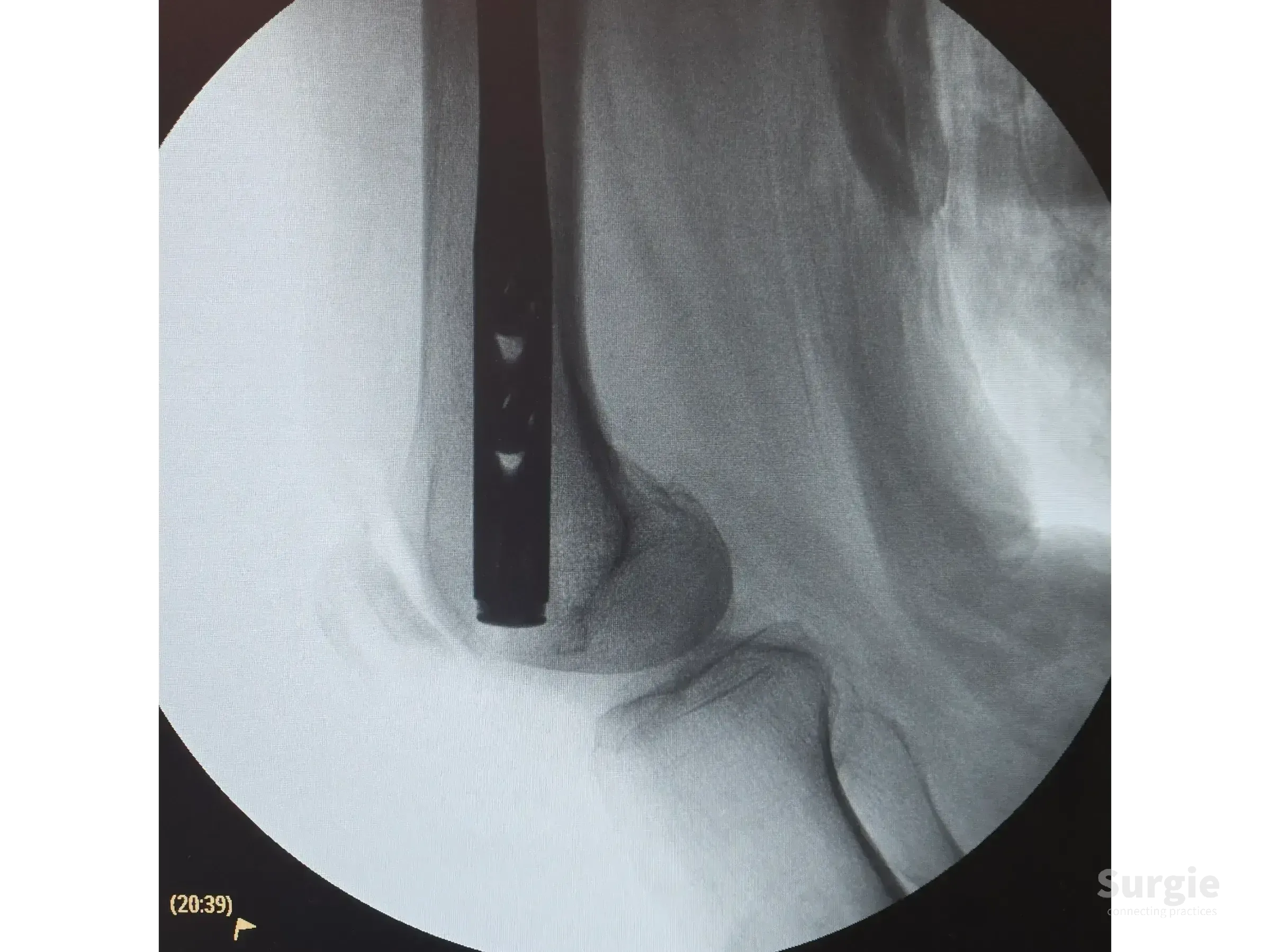 Fluoroscopic view of a retrograde intramedullary nail inserted into the distal femoral shaft for fracture fixation.