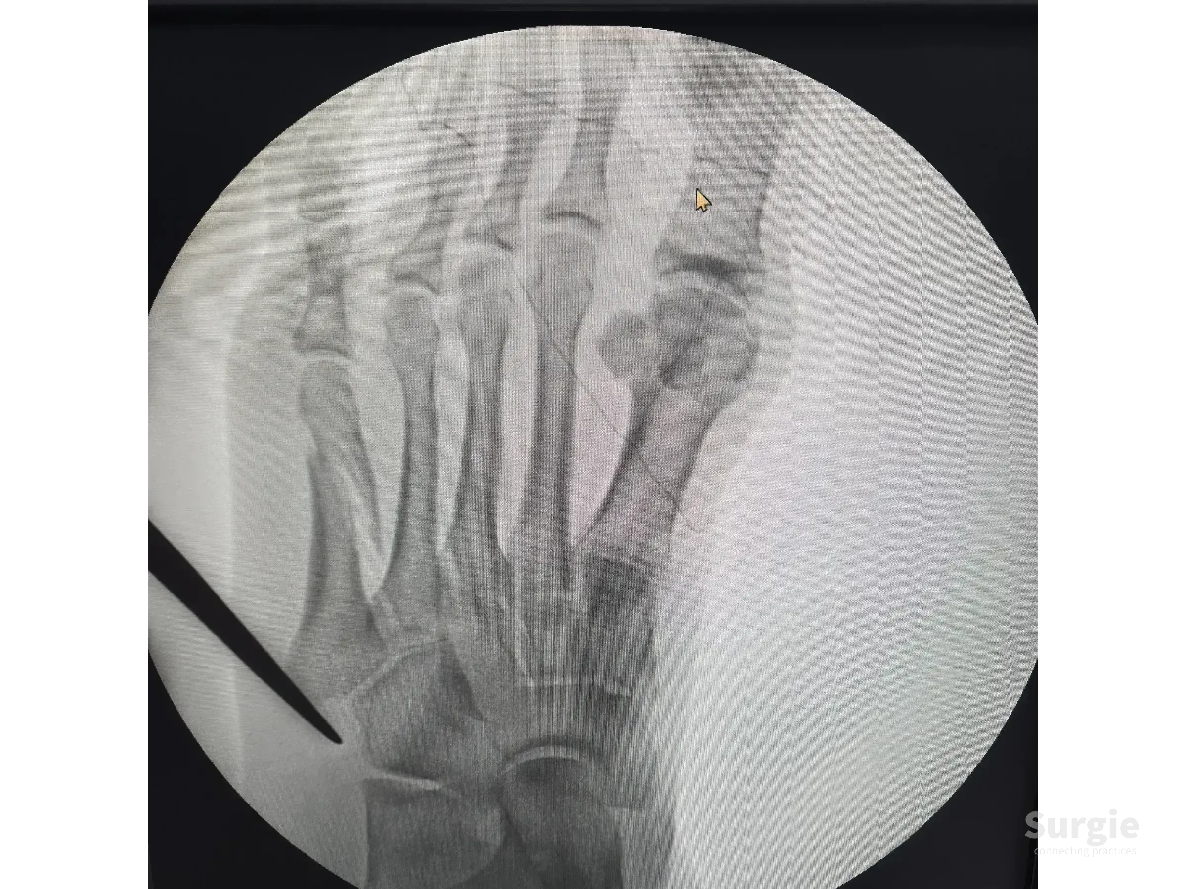 X-ray showing a displaced fifth metatarsal fracture stabilized with a low-profile titanium locking plate and screws.
