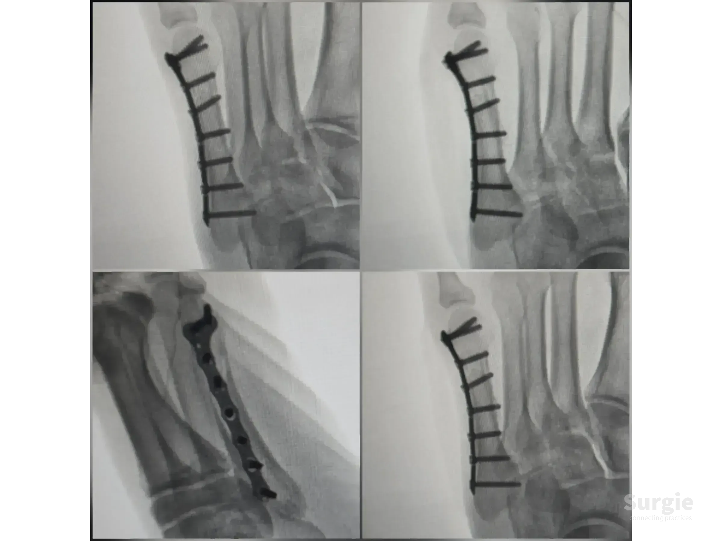 X-ray showing a 2.0 mm titanium locking plate and screws fixing a displaced fifth metatarsal fracture.