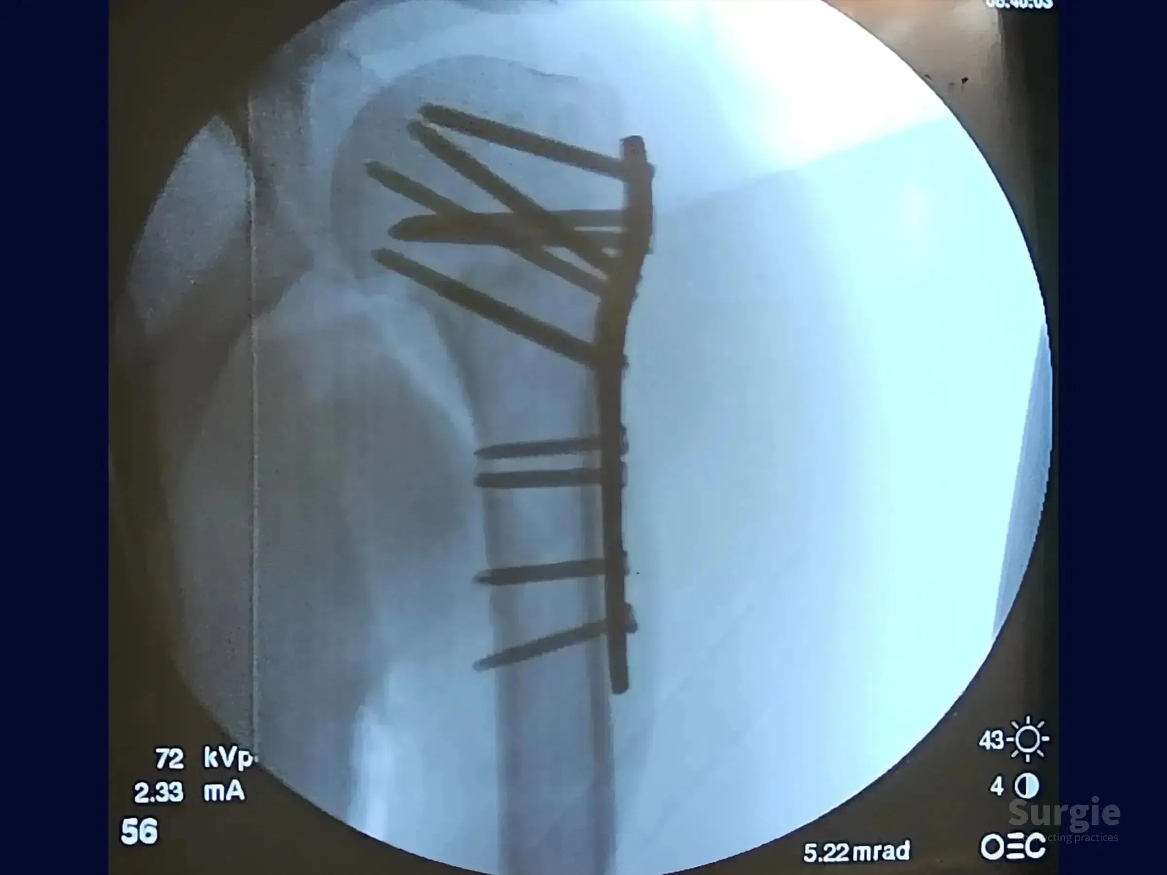 Fluoroscopic X-ray showing a metal plate and screw fixation on a four-part proximal humerus fracture.