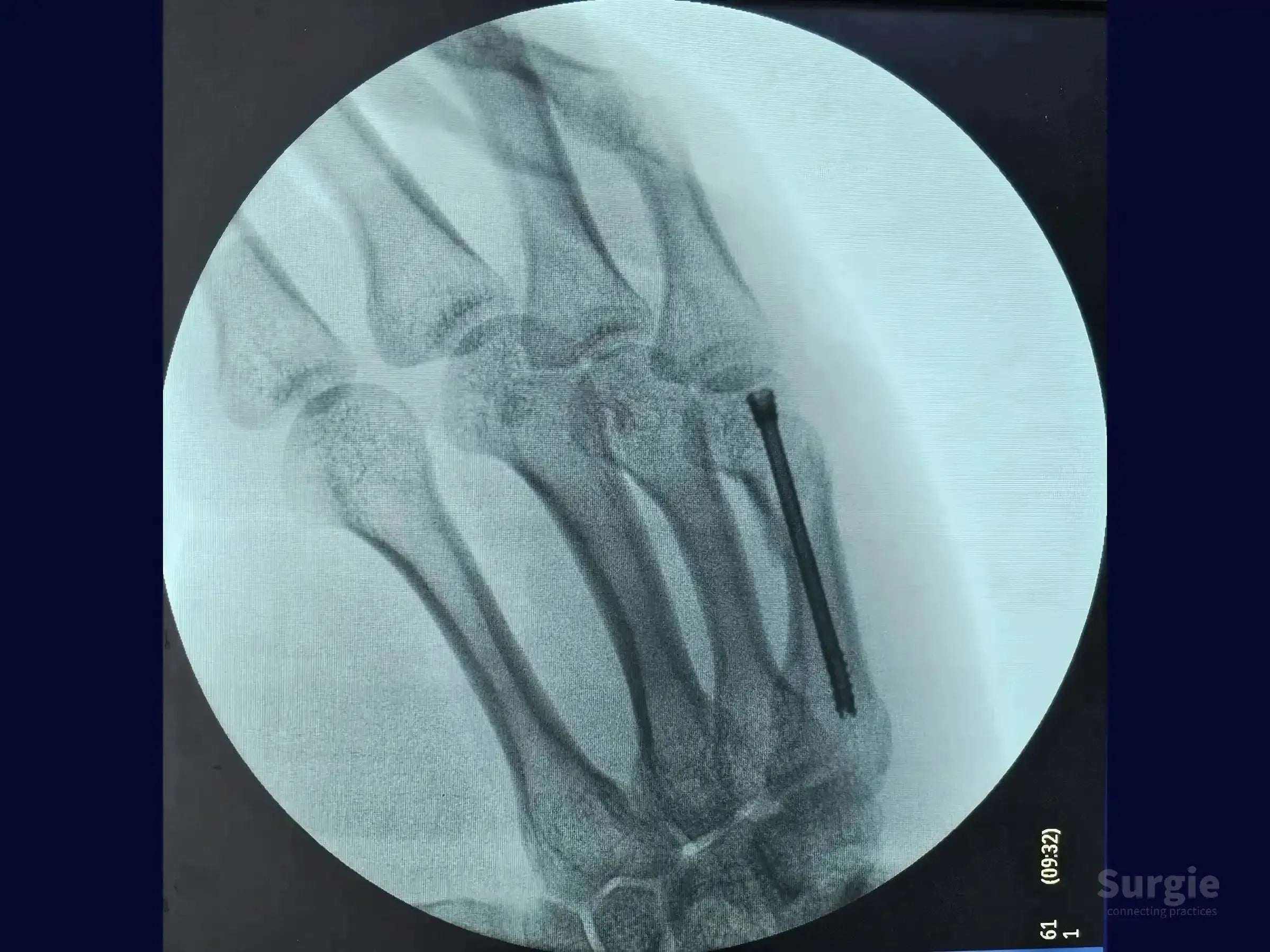 X-ray showing a fifth metacarpal boxer's fracture fixed with a metallic double-compression screw.