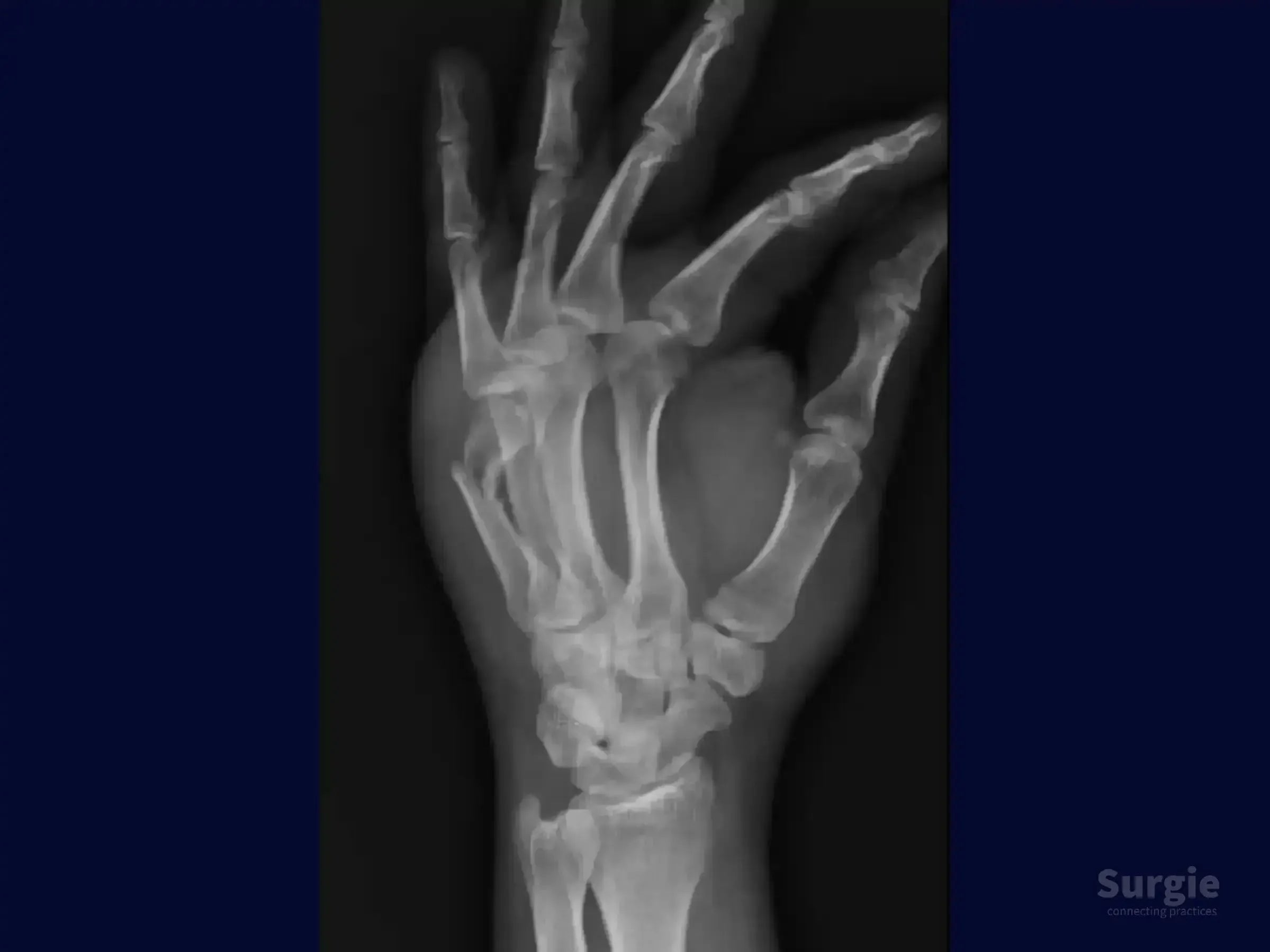 X-ray showing a fifth metacarpal neck fracture with significant angulation in a human hand.