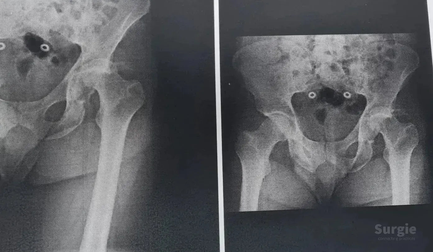 Pelvic X-ray showing a posterior acetabular wall fracture and hip dislocation in grayscale medical imaging.