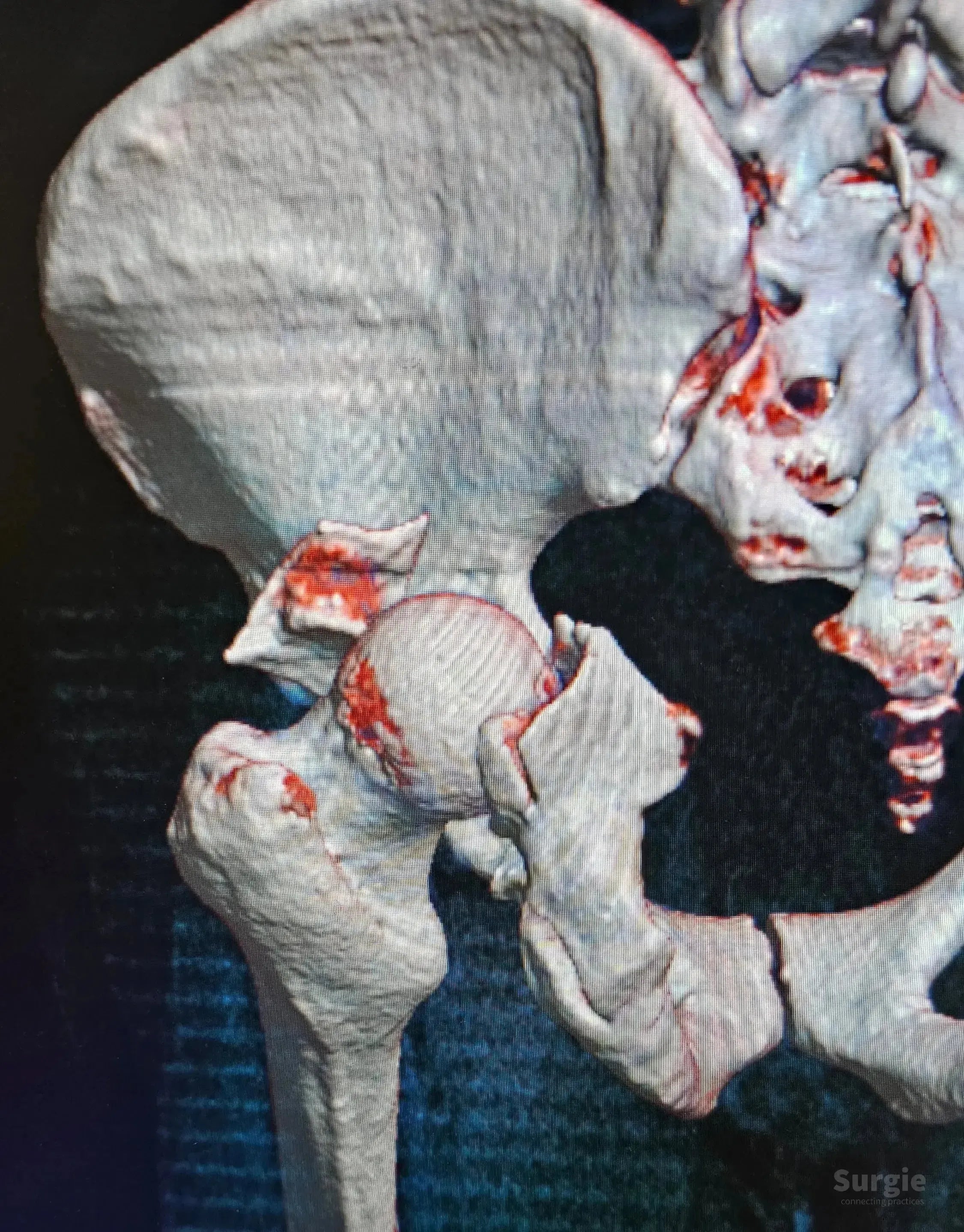 3D CT scan showing a posterior acetabular wall fracture with hip dislocation and bone fragment displacement.