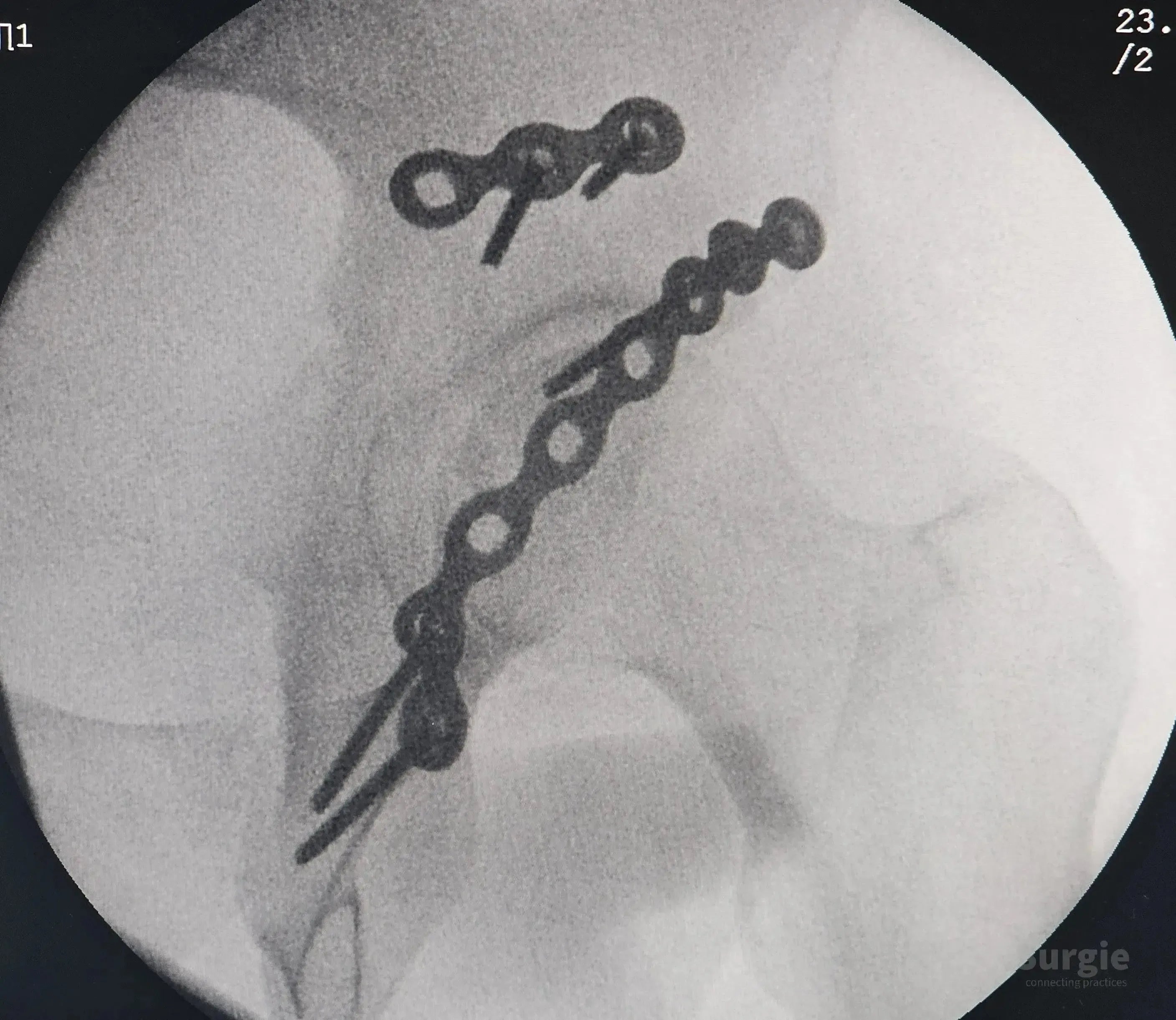 X-ray showing metal plates and screws fixating a posterior acetabular wall fracture after hip dislocation surgery.