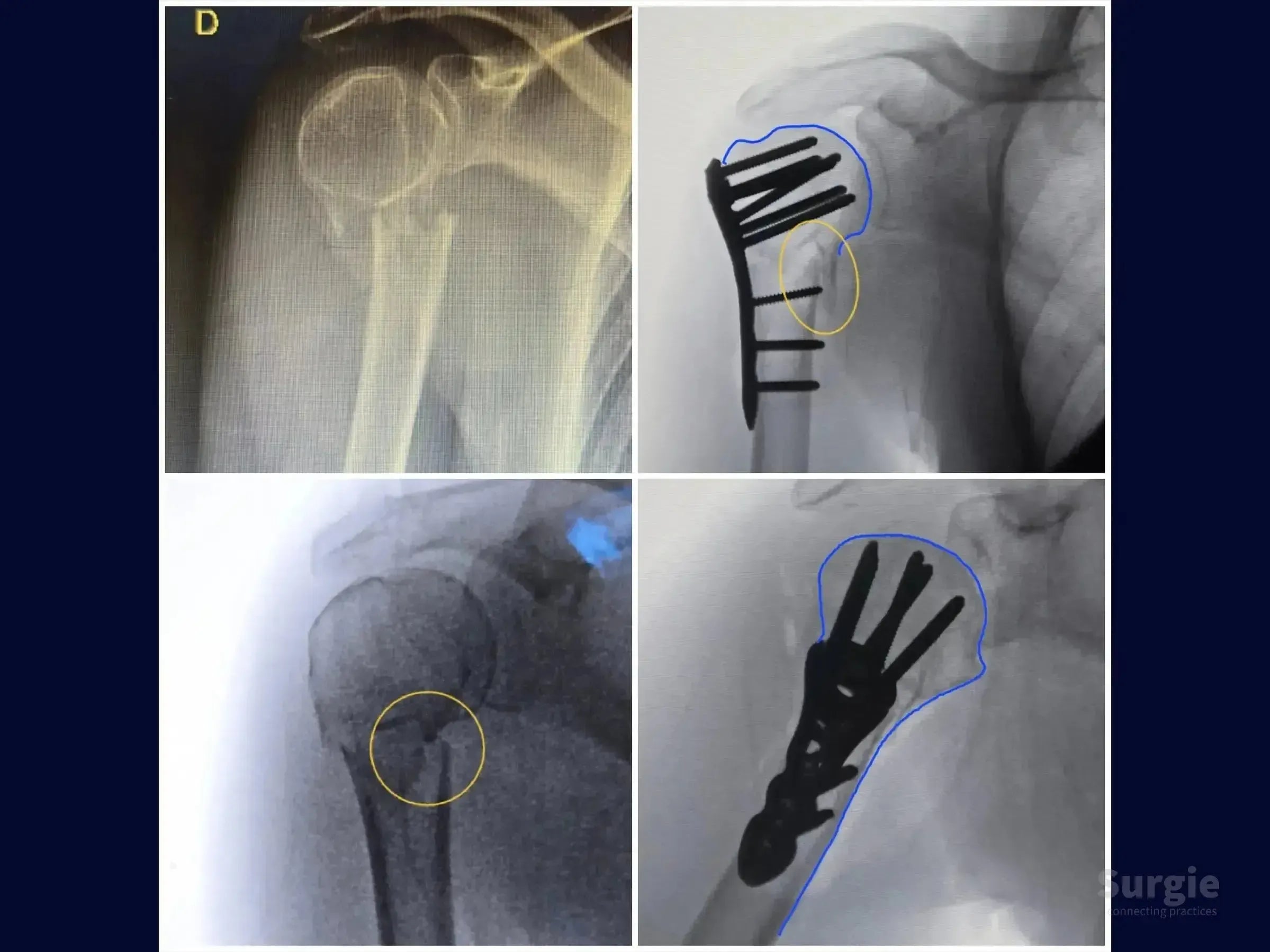 X-ray sequence showing a proximal humerus fracture before and after surgical plate and screw fixation.