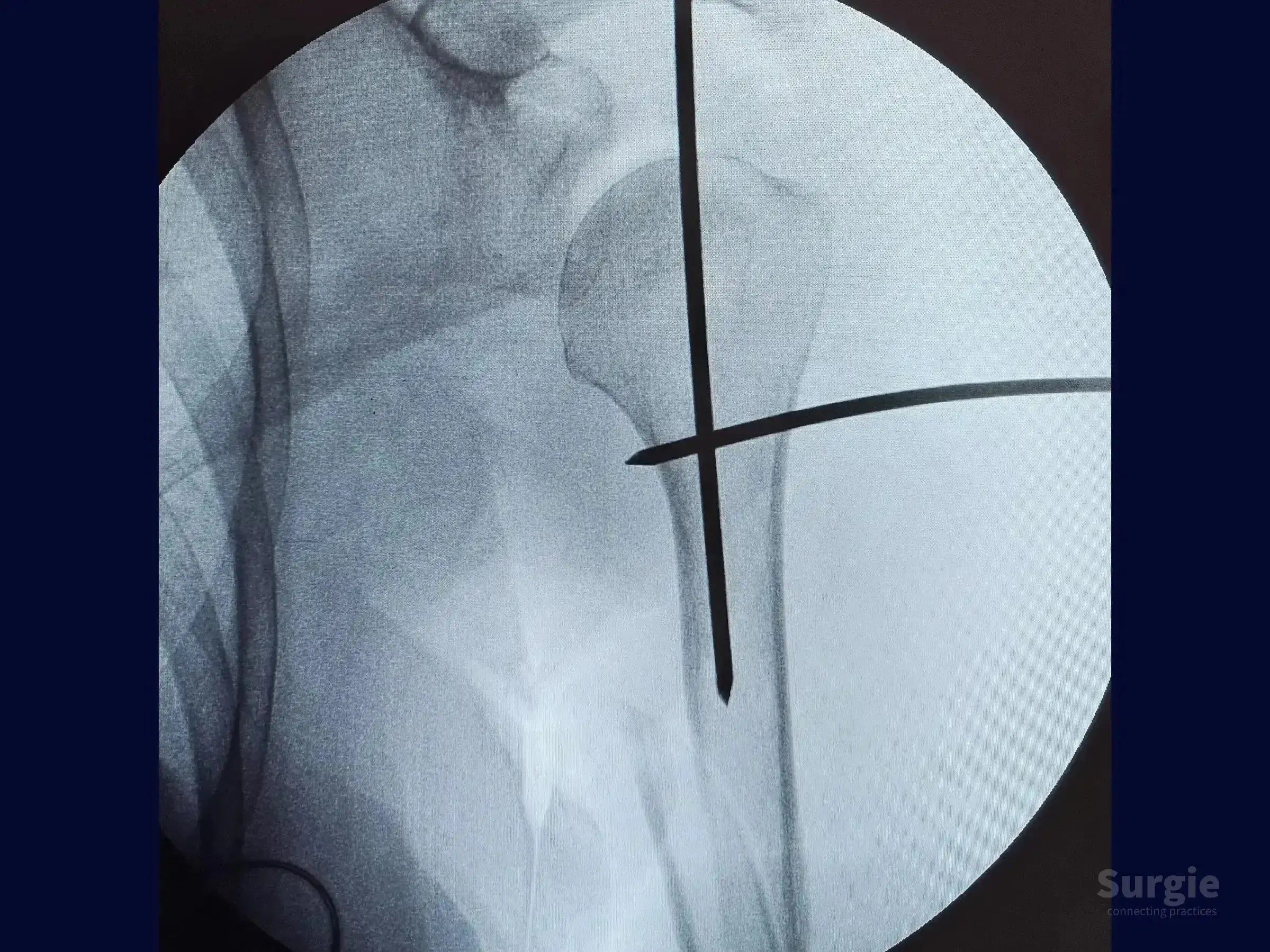 Fluoroscopic view of a humeral shaft fracture with Kirschner wire joystick for proximal fragment reduction.