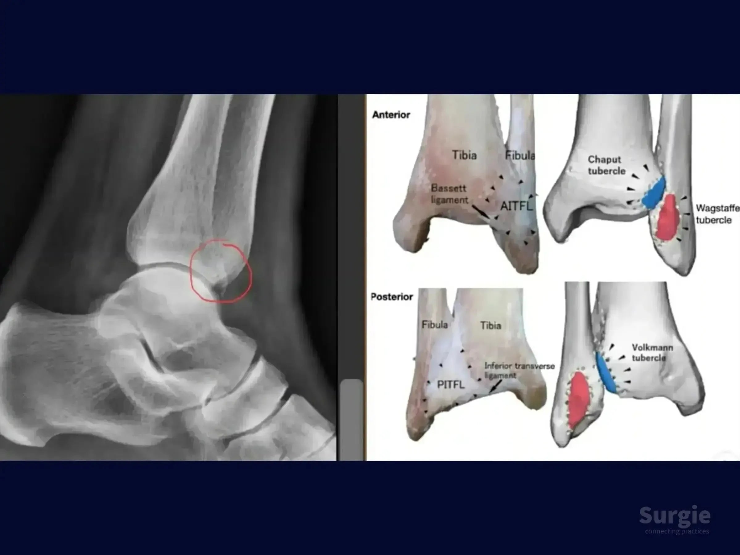 Ankle X-ray showing a Wagstaffe fracture fragment alongside anatomical diagrams of the tibia and fibula ligaments.