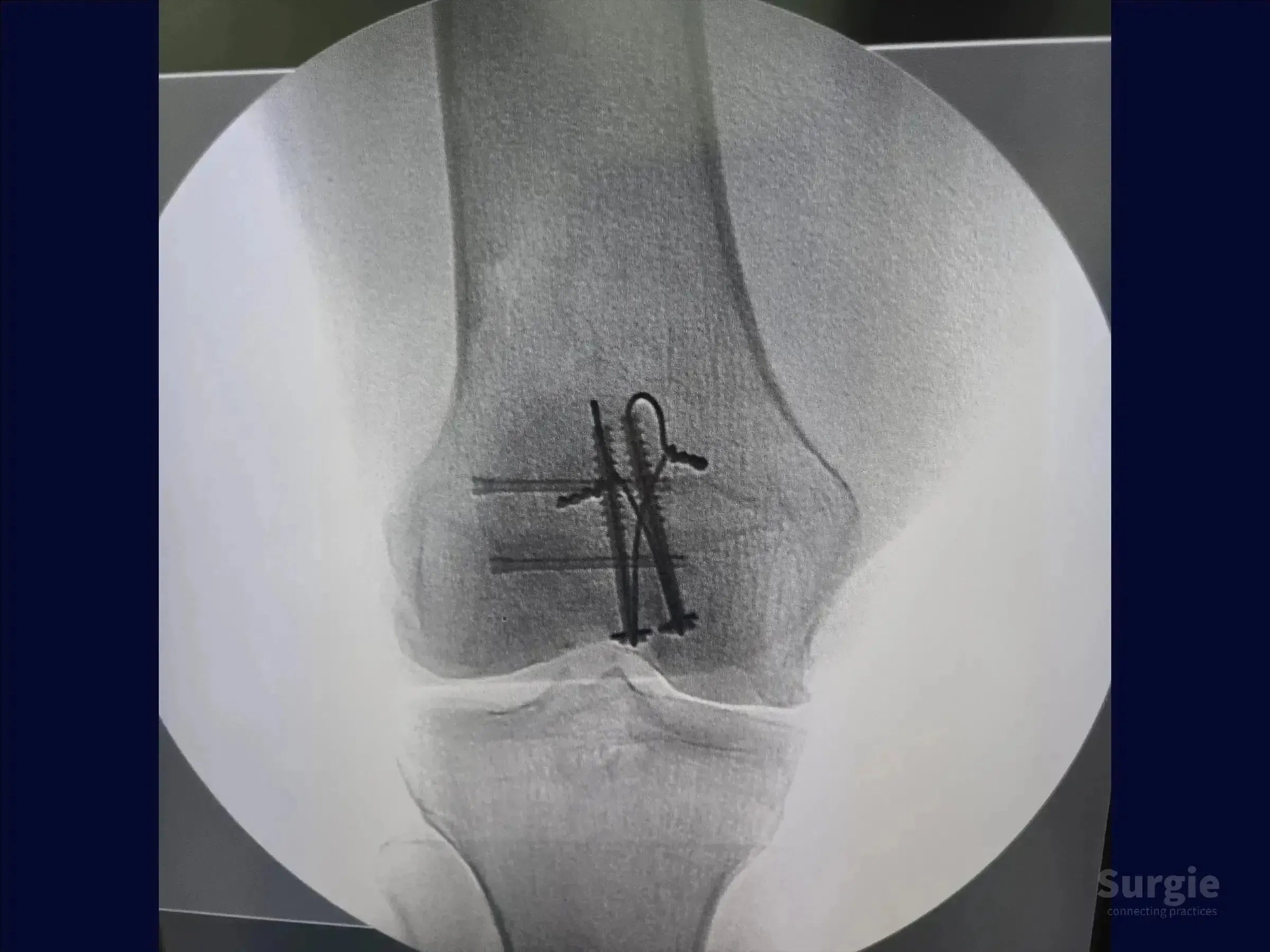 X-ray showing a patella fracture fixed with cannulated screws and cerclage wiring for stable anatomical reduction.