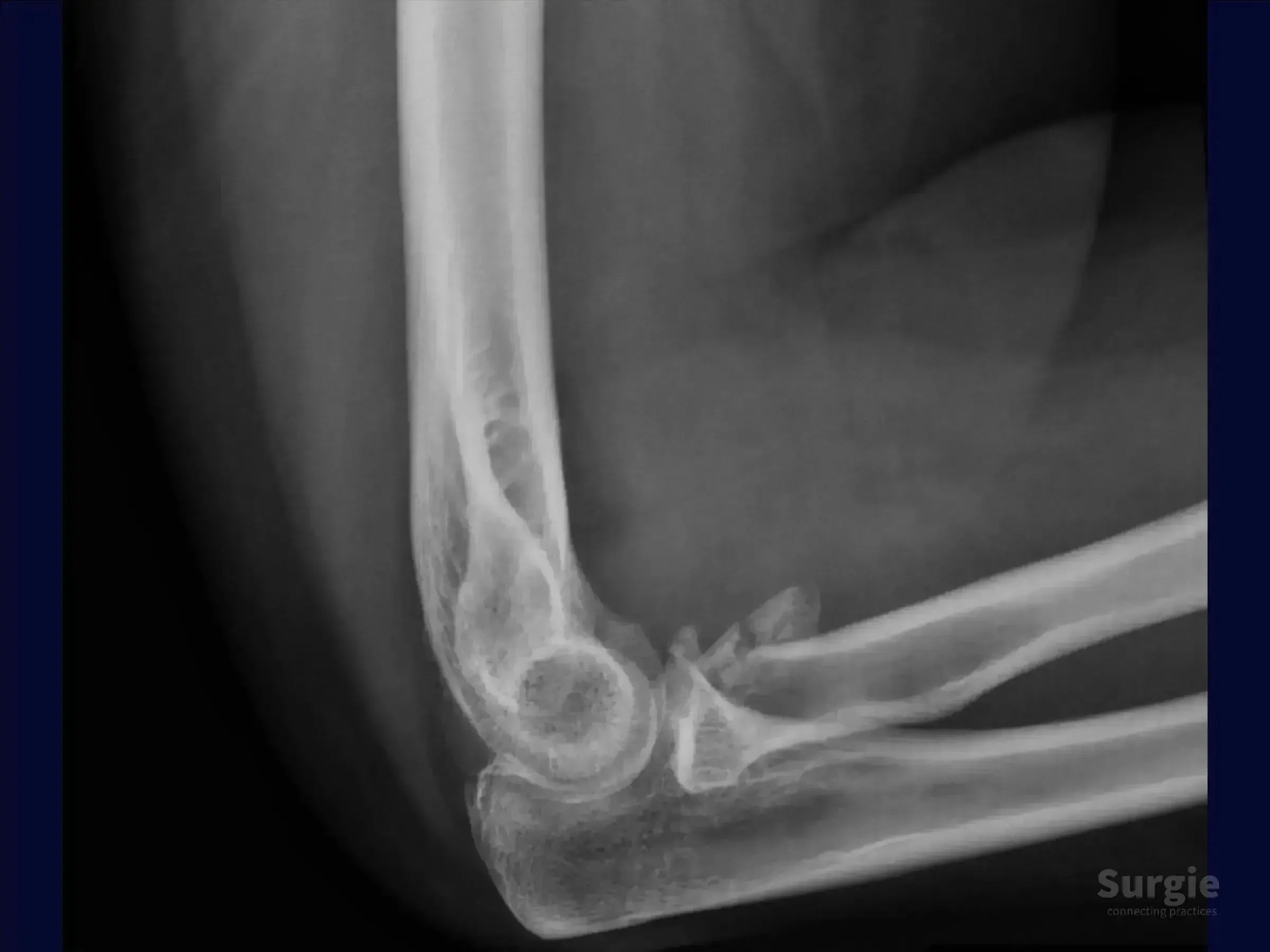 Lateral elbow X-ray showing a complex Mason 3 multifragmentary radial head fracture with coronoid process involvement.