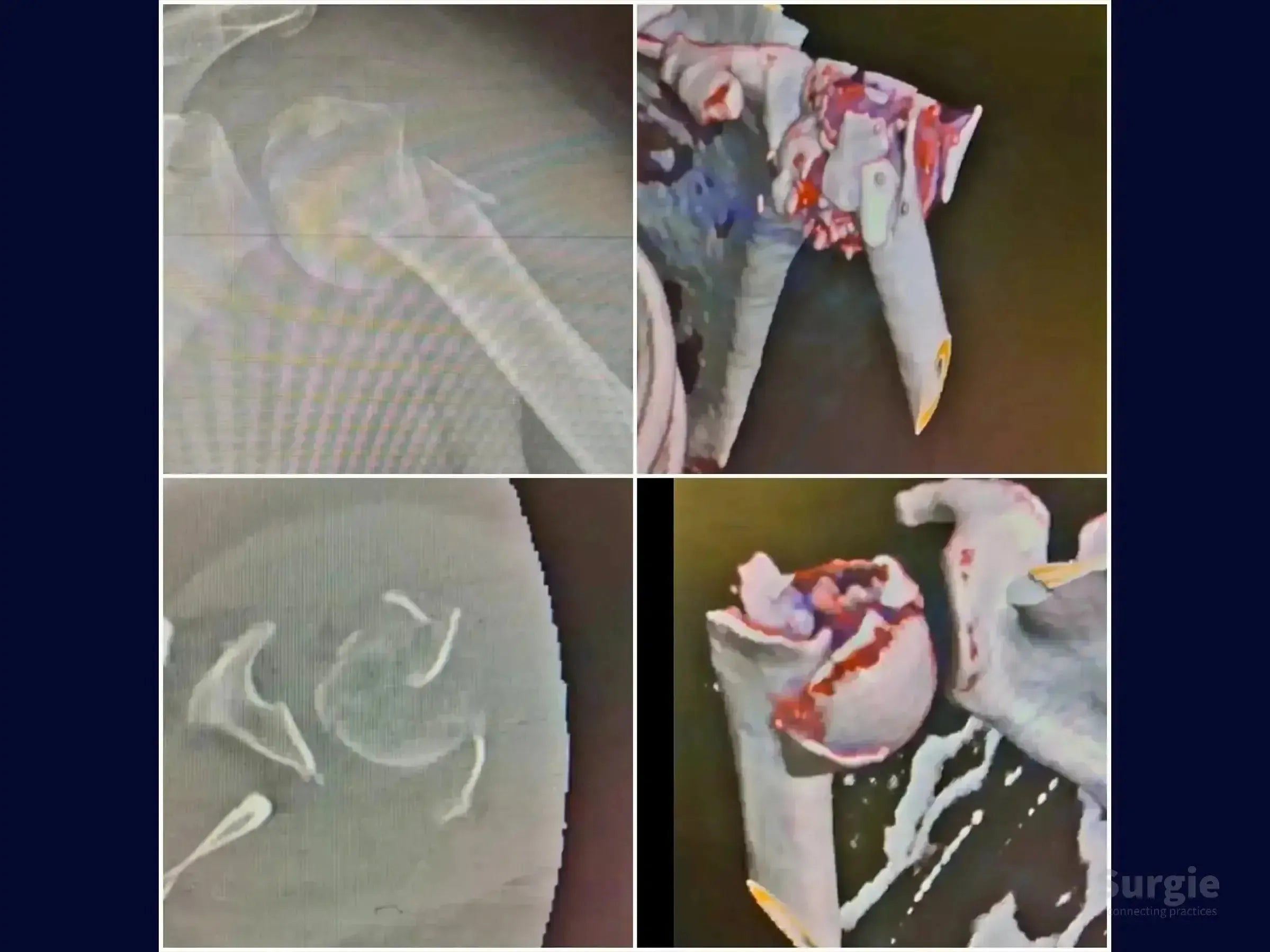 Radiographic and 3D CT scans showing a complex four-part proximal humerus fracture reconstruction.