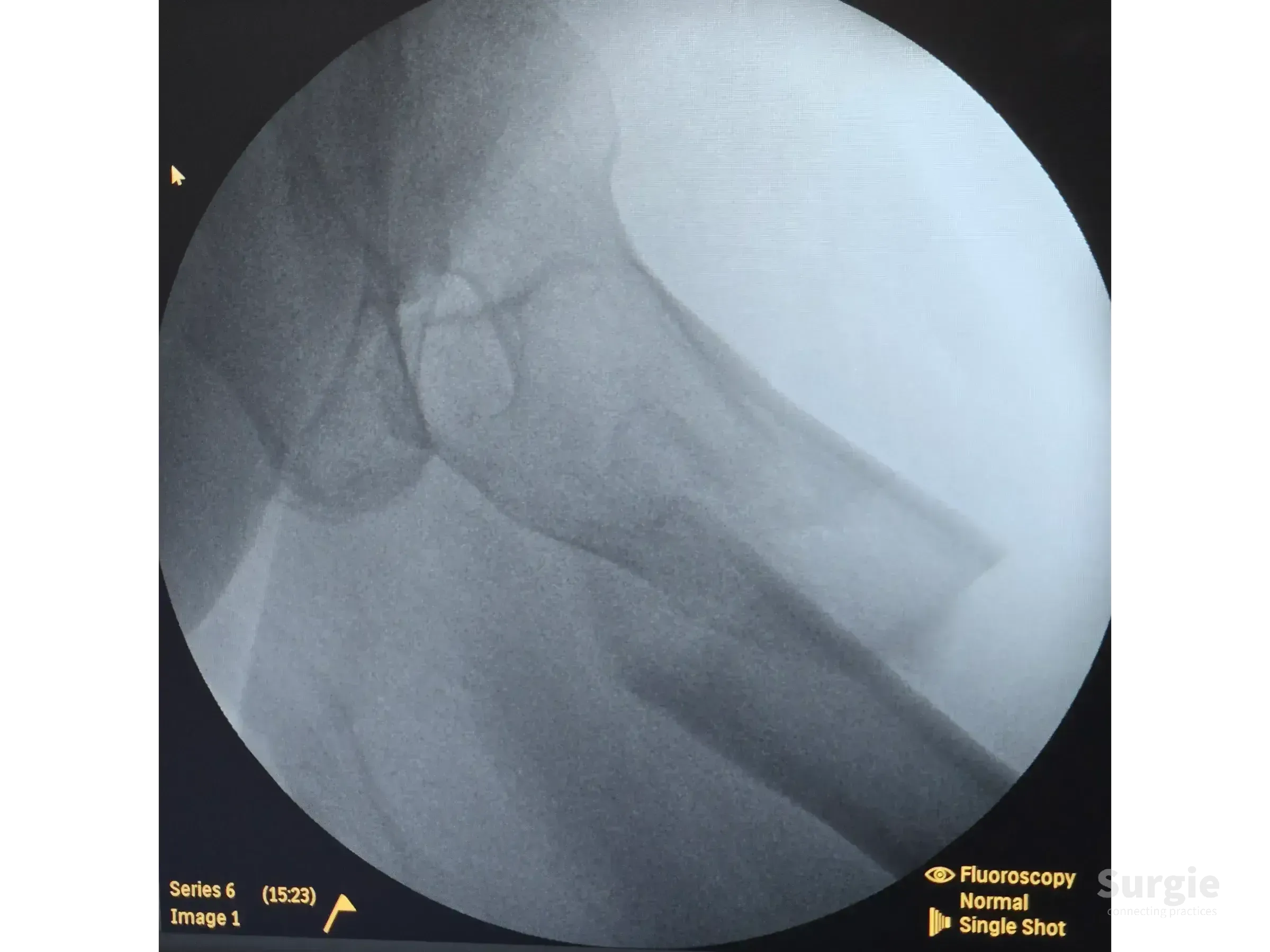 Fluoroscopic X-ray showing a subtrochanteric femur fracture with proximal fragment displacement and misalignment.