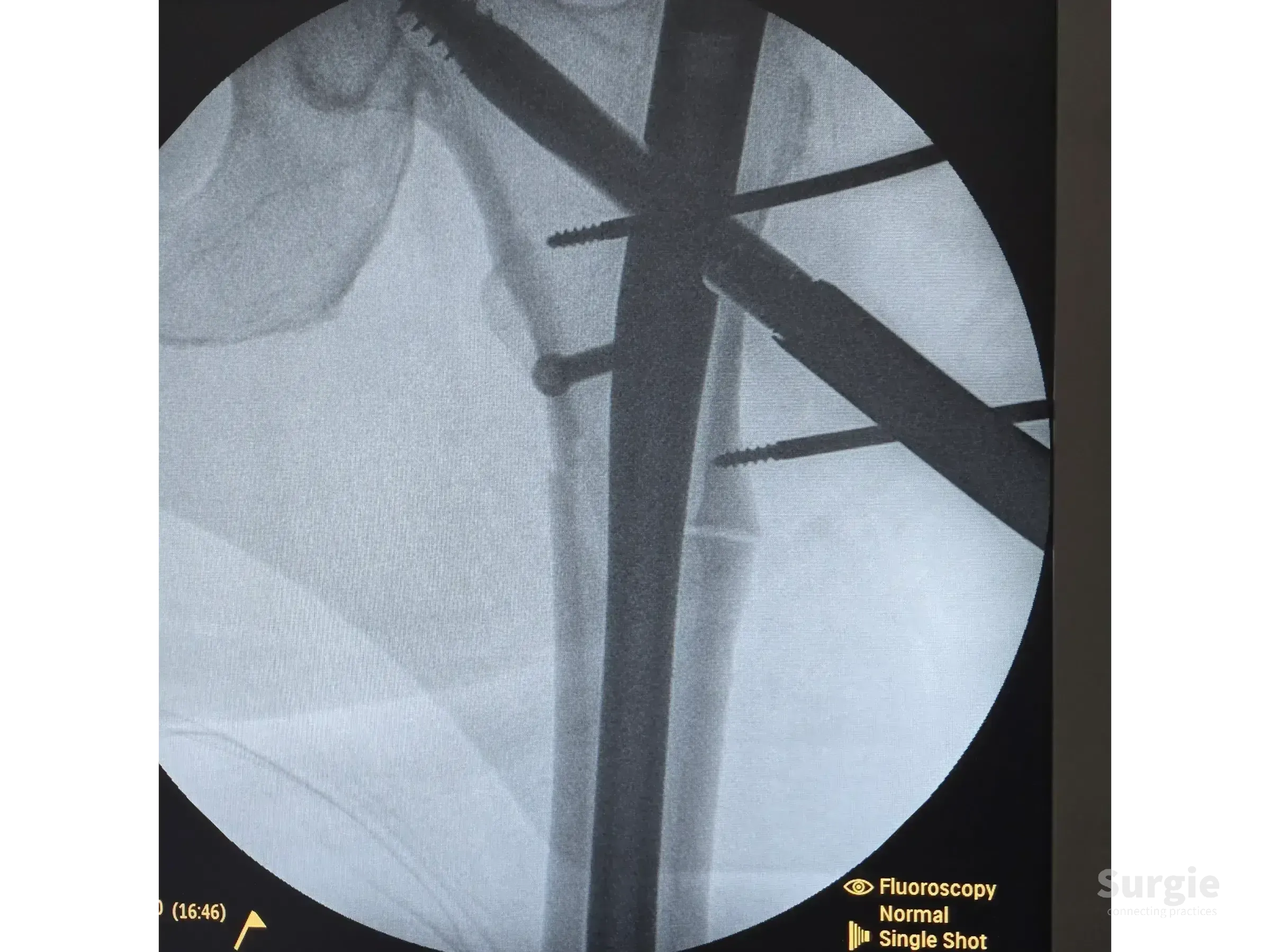 Fluoroscopic X-ray showing a metal intramedullary nail fixating a subtrochanteric femoral fracture with locking screws.