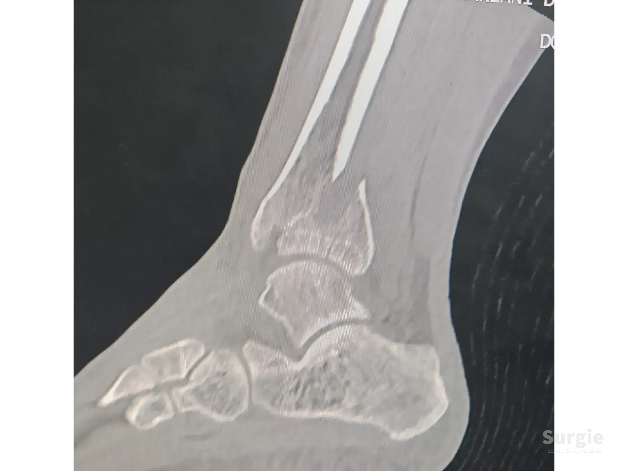Sagittal CT scan showing a complex tibial pilon fracture with displaced distal tibia fragments and joint involvement.