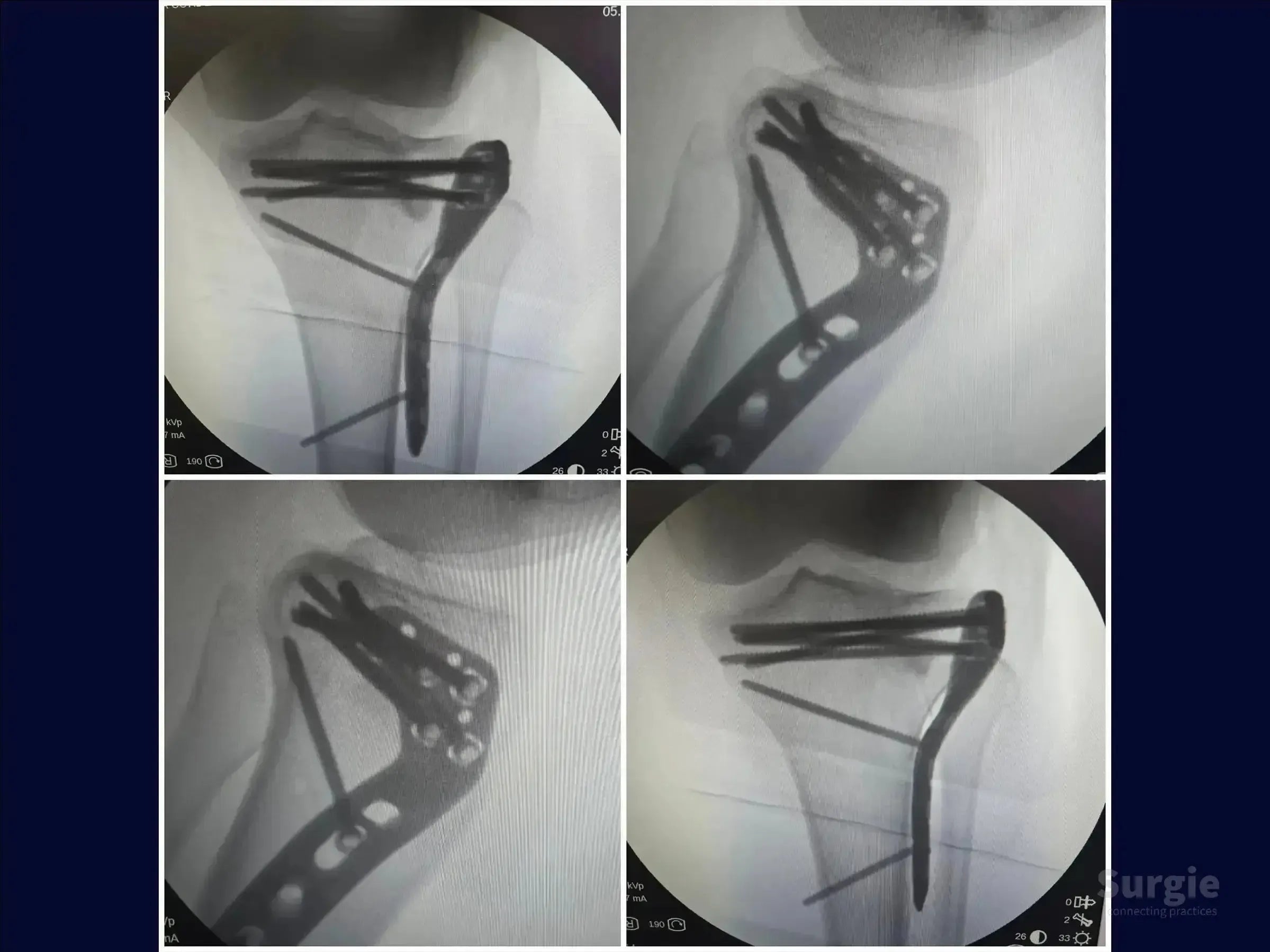 X-ray showing a tibial plateau fracture repaired with a metal plate and multiple screws for anatomical stabilization.