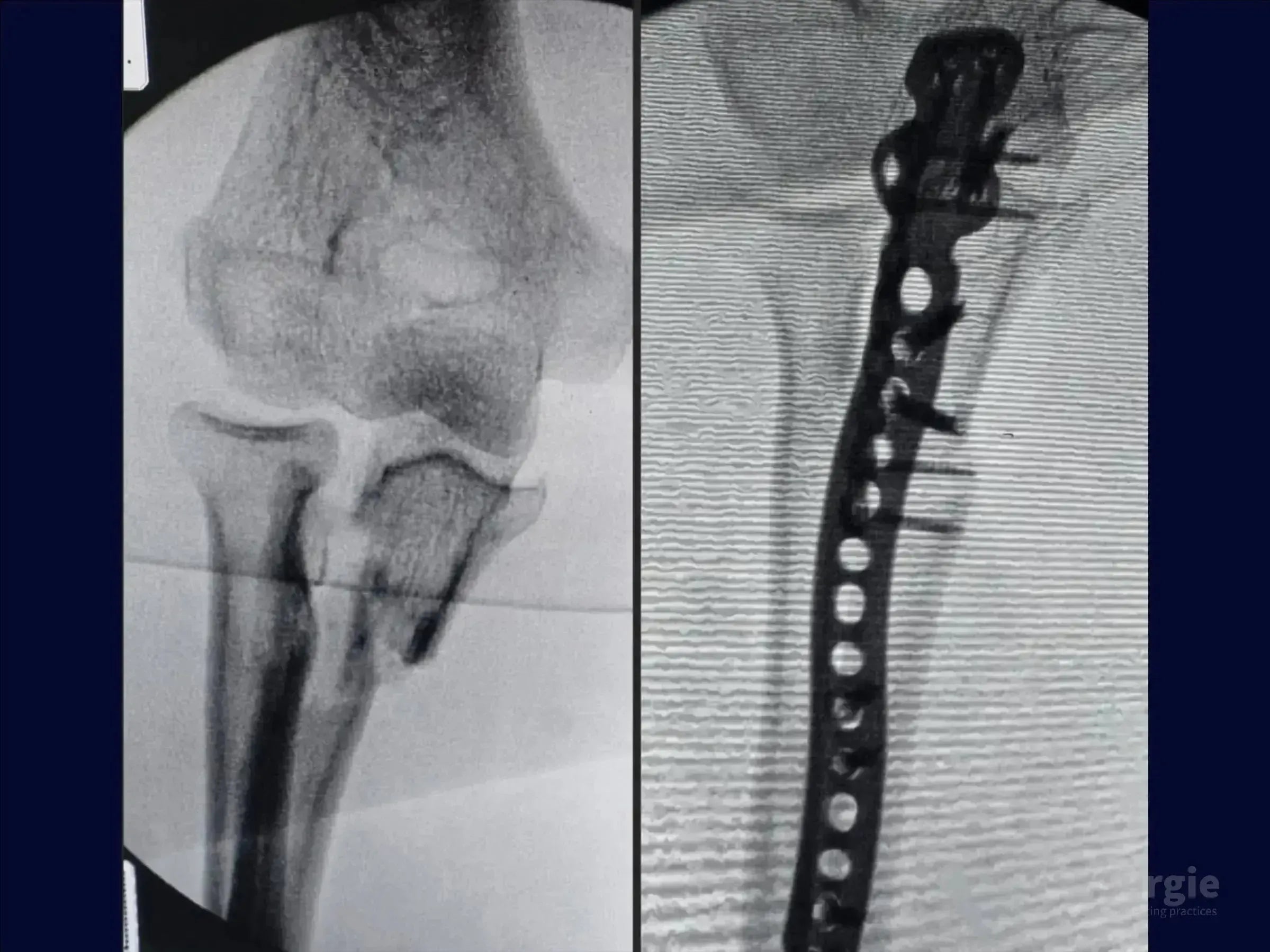 X-ray showing a transolecranon fracture-dislocation before and after surgical fixation with a metal plate and screws.