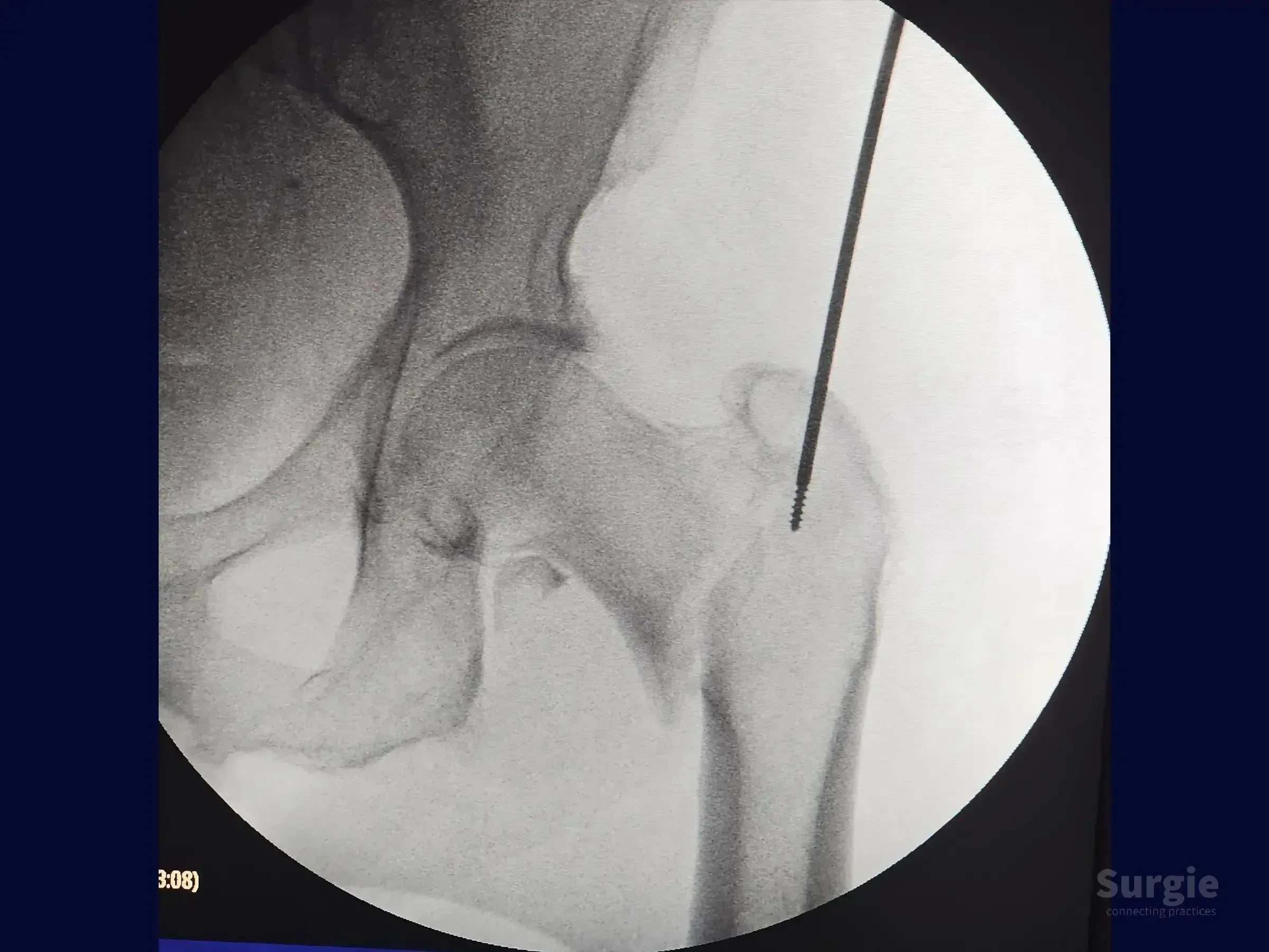 Fluoroscopic view of a proximal femur fracture with a guidewire inserted into the femoral head for intramedullary nailing.