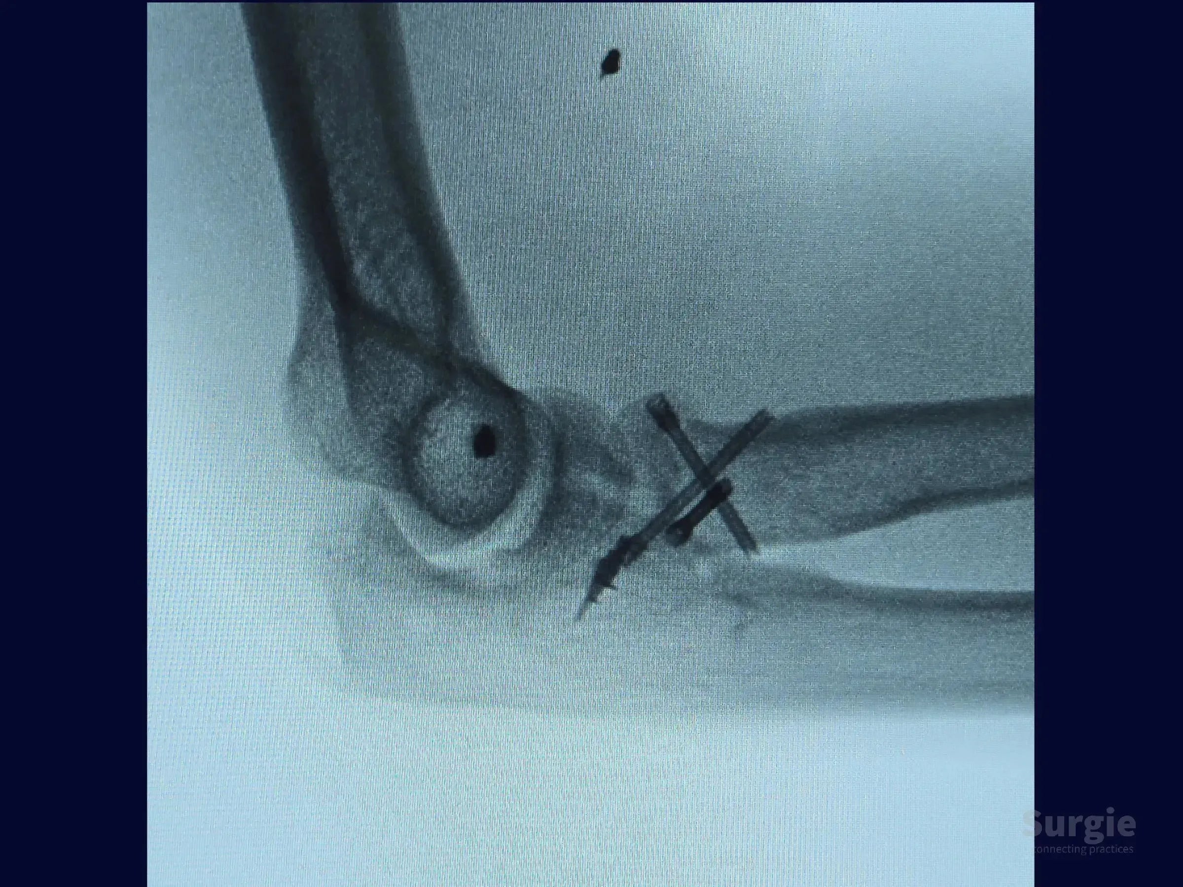 X-ray showing radial head fixation with two crossed compression screws and a metallic anchor in the elbow joint.