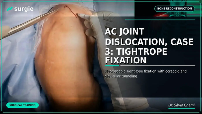 AC Joint Dislocation, Case 3: TightRope Fixation