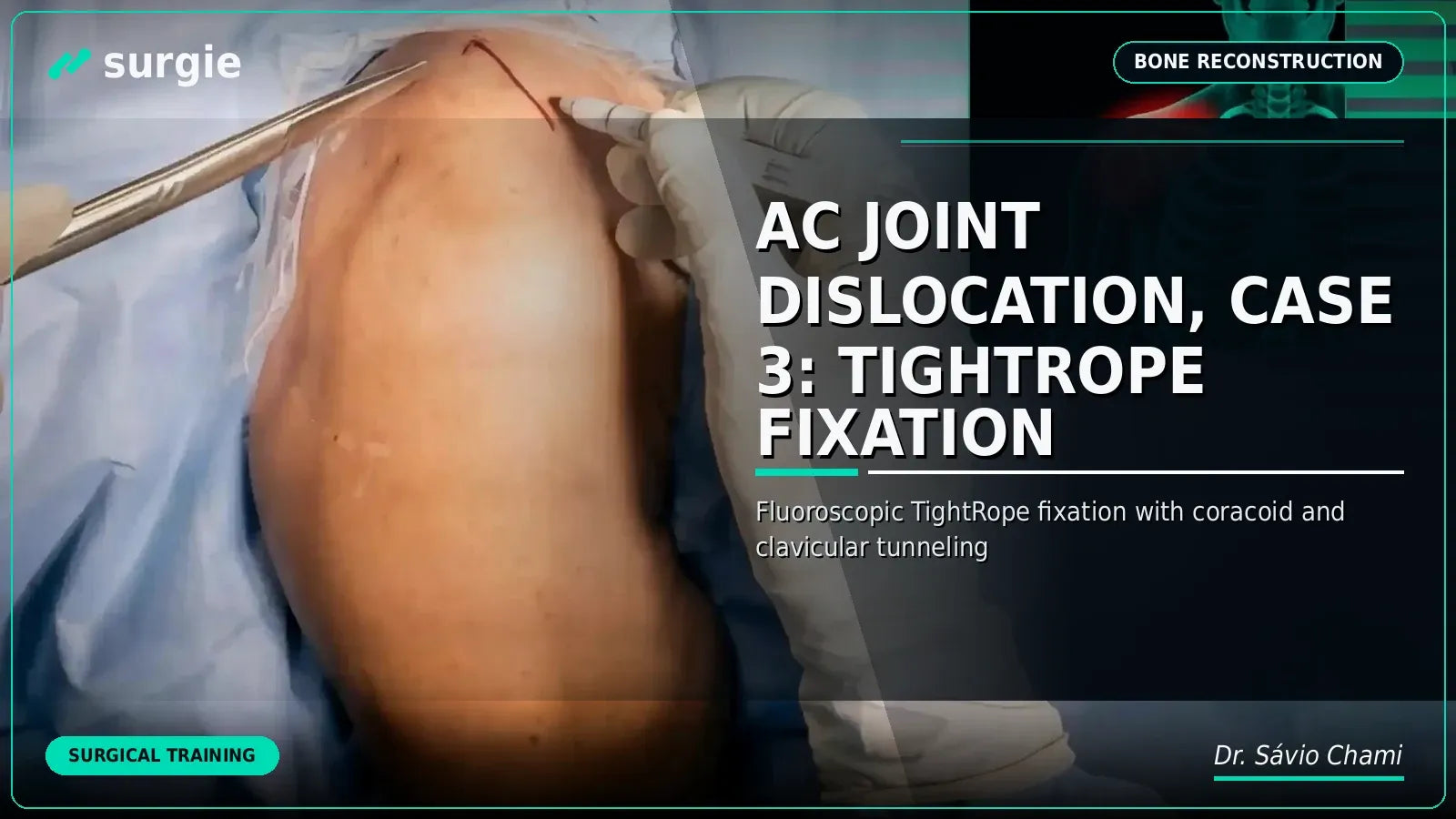 AC Joint Dislocation, Case 3: TightRope Fixation