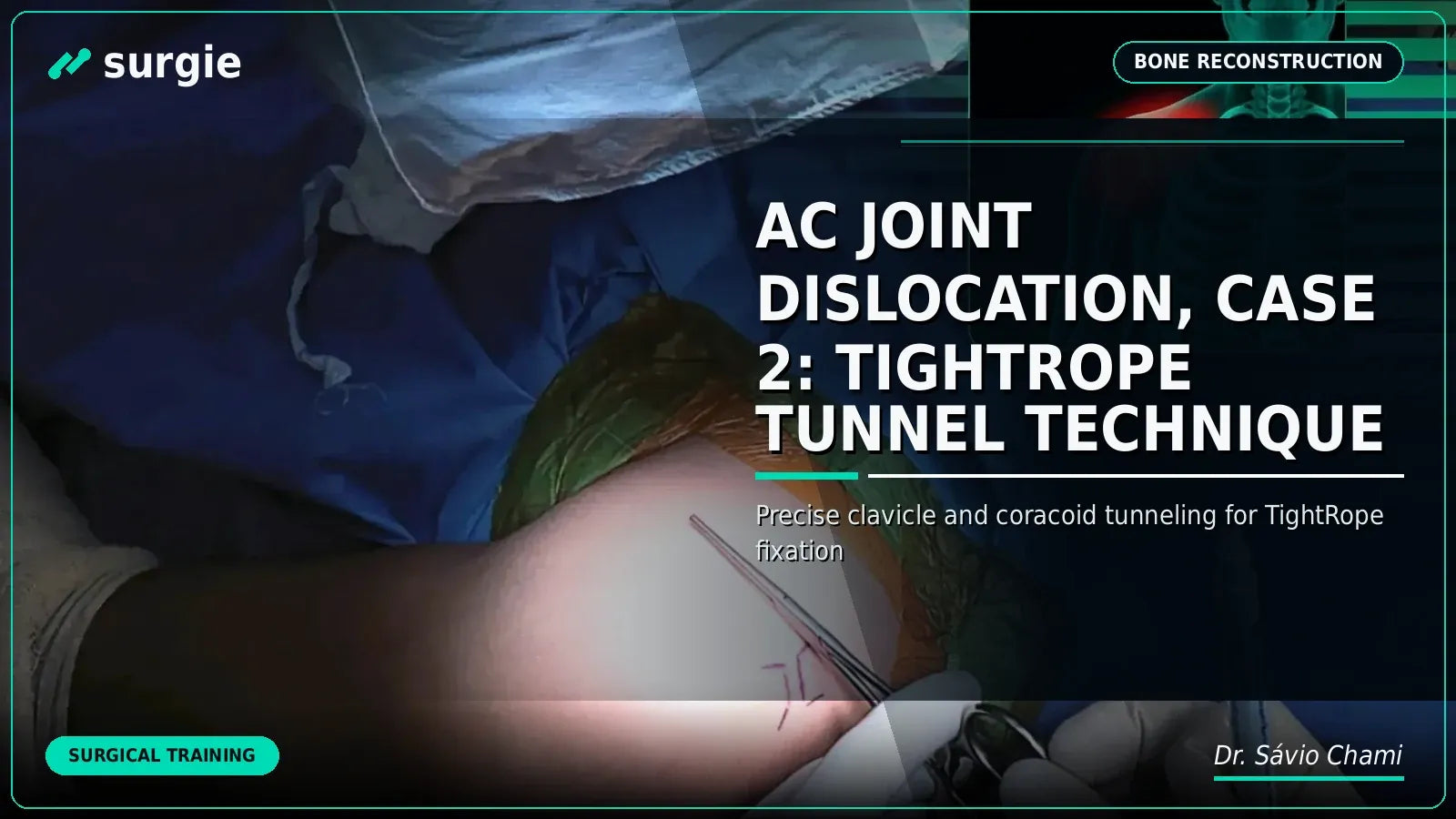 Luxação da Articulação AC, Caso 2: Técnica do Túnel TightRope