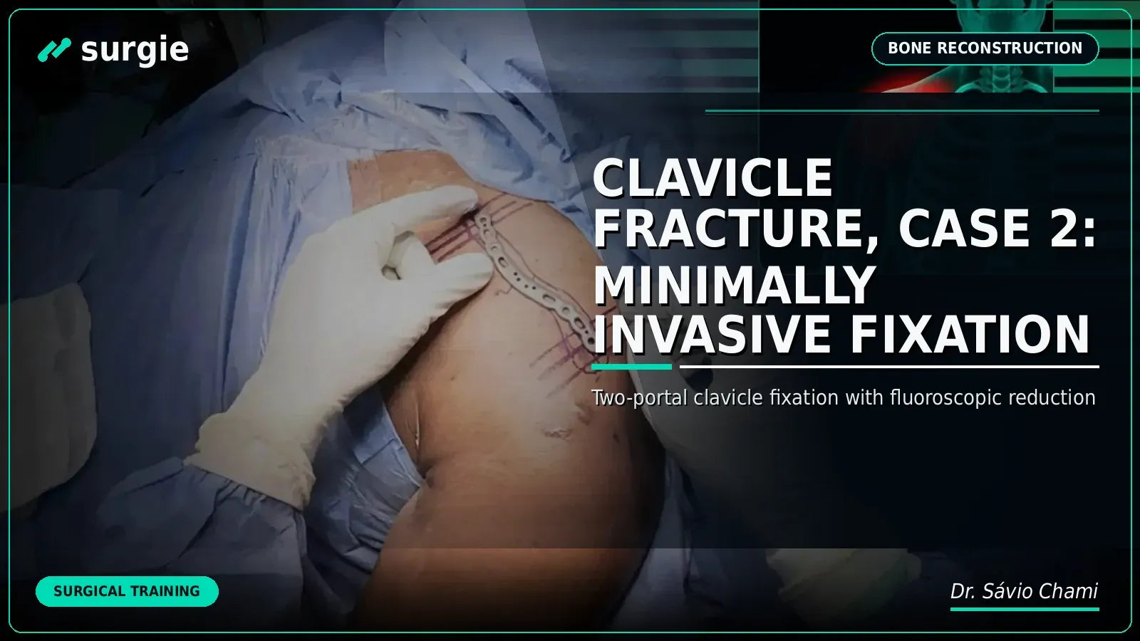 Clavicle Fracture, Case 2: Minimally Invasive Fixation