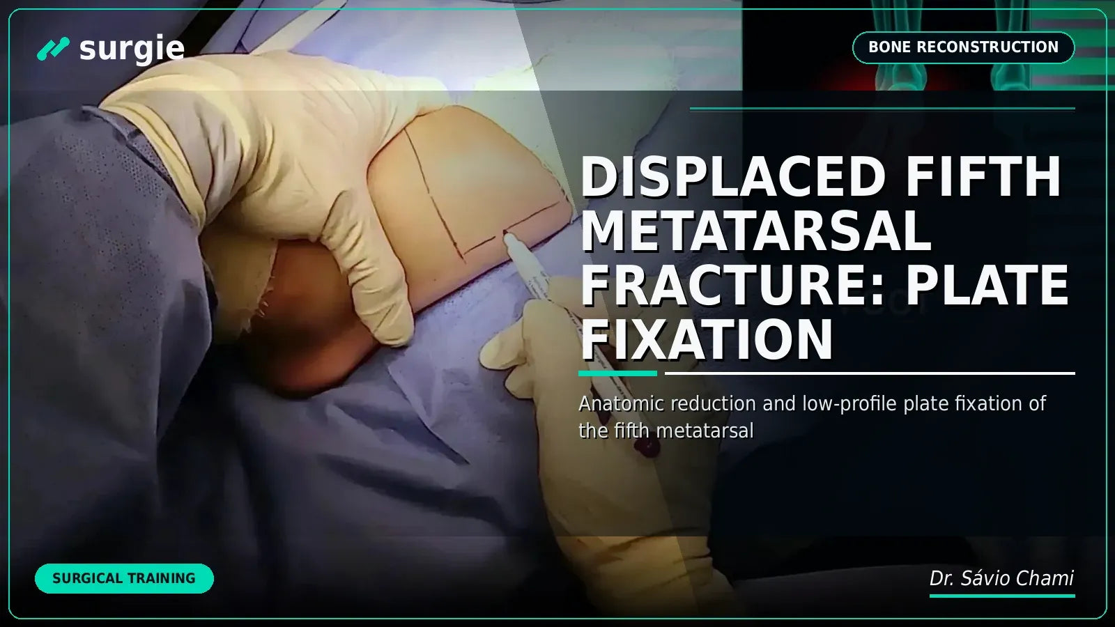 Fratura Deslocada do Quinto Metatarso: Fixação com Placa