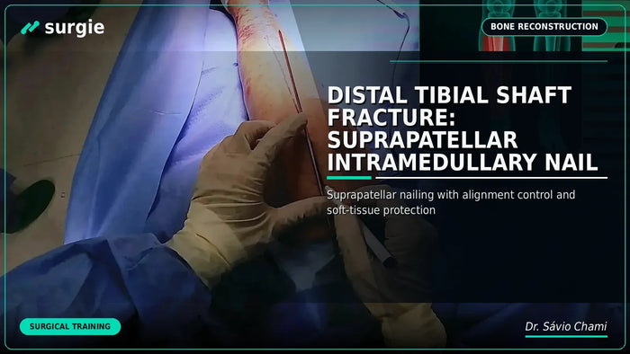 Fratura do Terço Distal da Tíbia: Haste Intramedular Suprapatelar