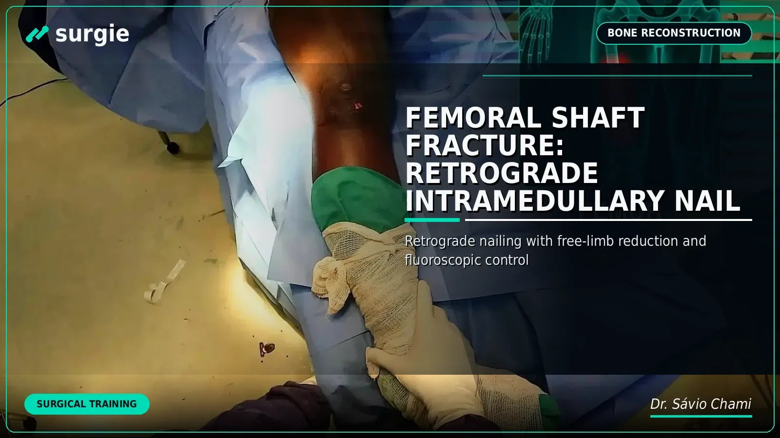 Femoral Shaft Fracture: Retrograde Intramedullary Nail