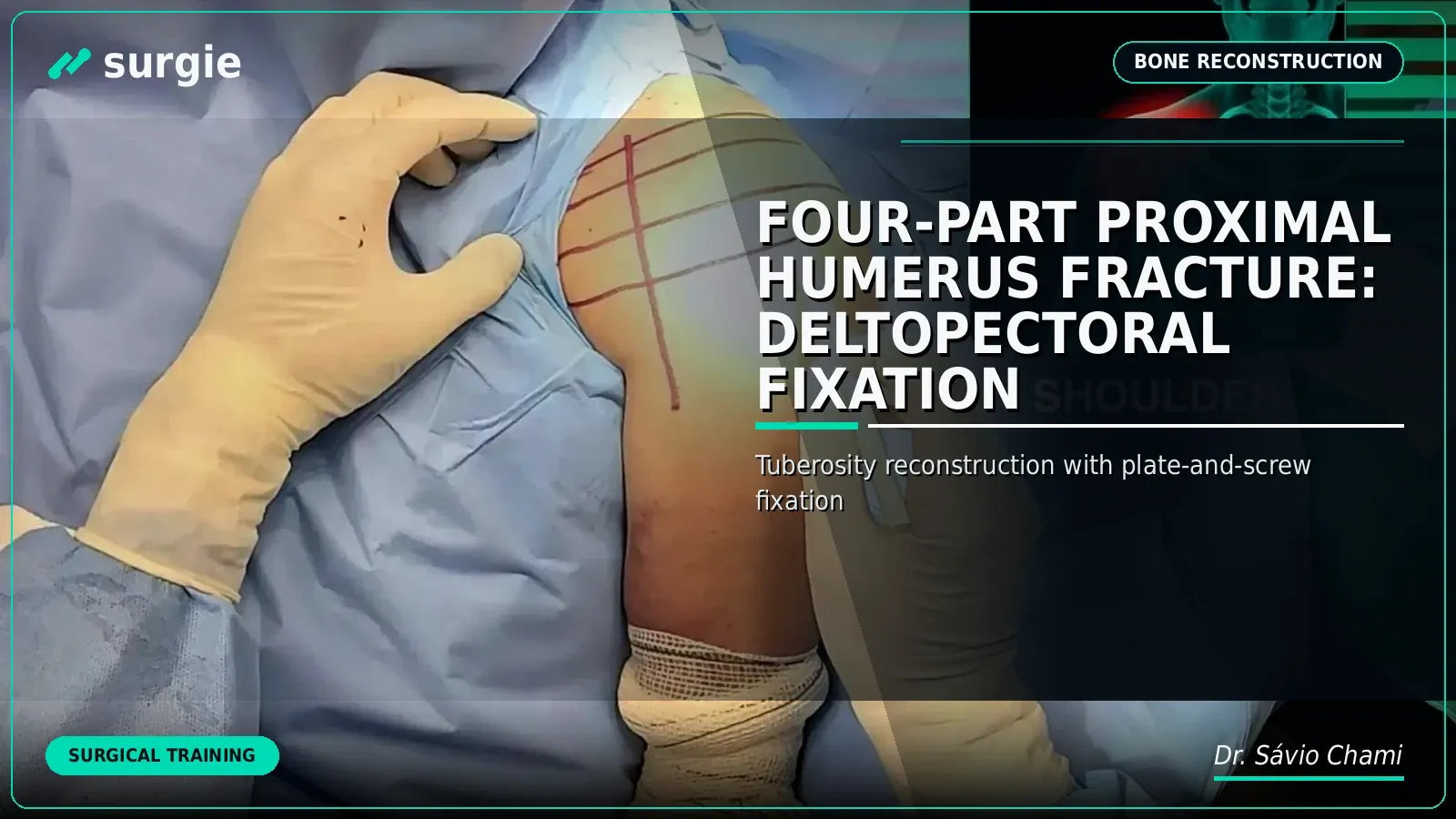 Four-Part Proximal Humerus Fracture: Deltopectoral Fixation