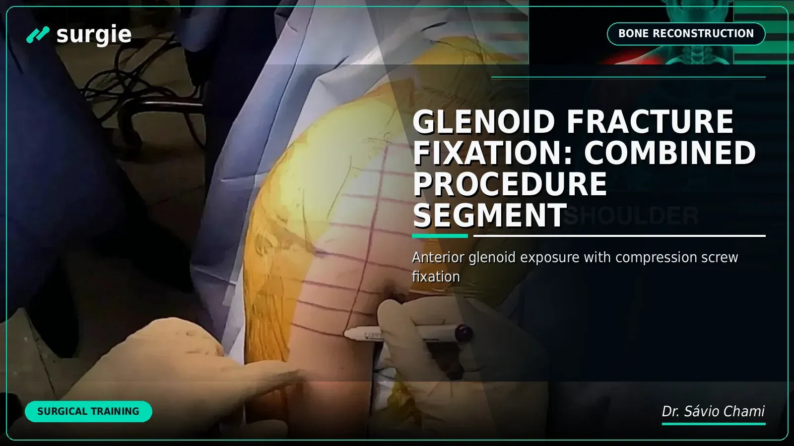 Glenoid Fracture Fixation: Combined Procedure Segment