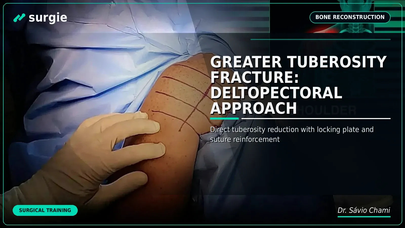 Greater Tuberosity Fracture: Deltopectoral Approach
