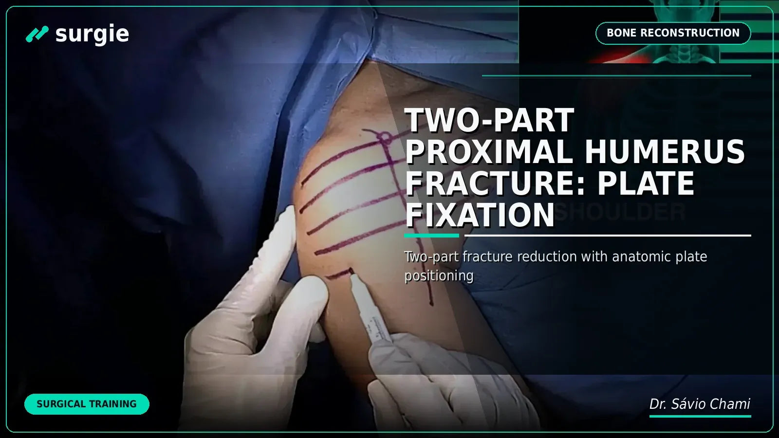 Two-Part Proximal Humerus Fracture: Plate Fixation