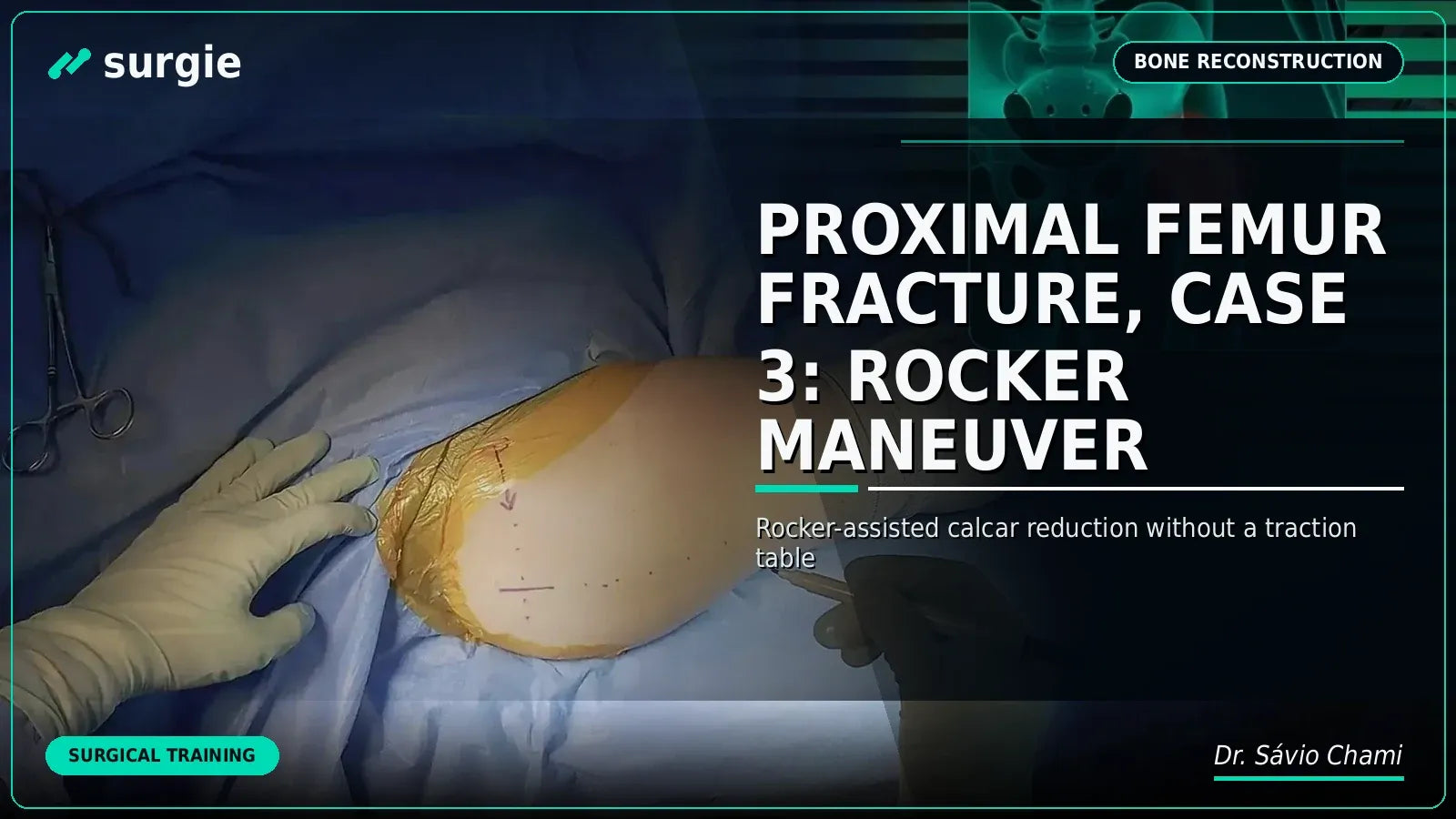 Proximal Femur Fracture, Case 3: Rocker Maneuver