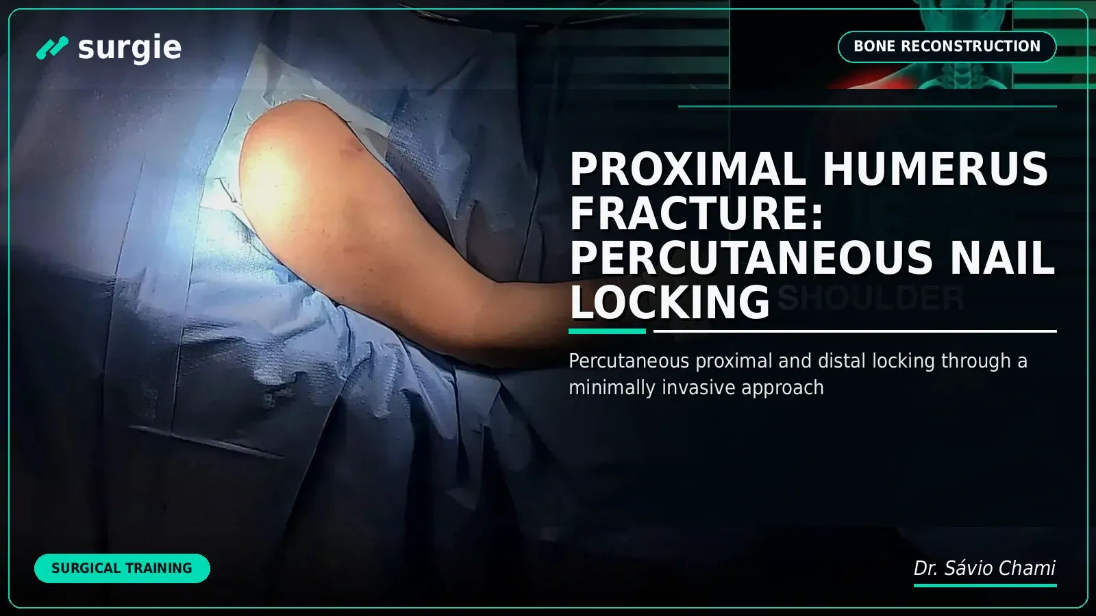 Fratura do Úmero Proximal: Bloqueio Percutâneo com Haste