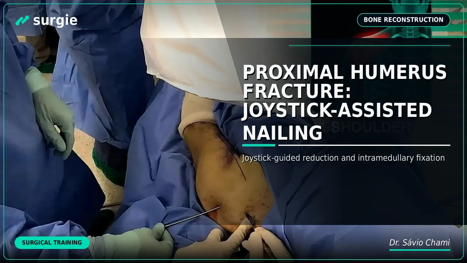 Fratura do úmero proximal: Fixação intramedular assistida por joystick