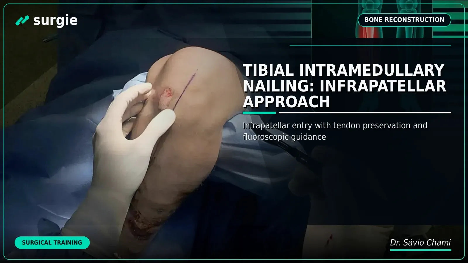 Tibial Intramedullary Nailing: Infrapatellar Approach