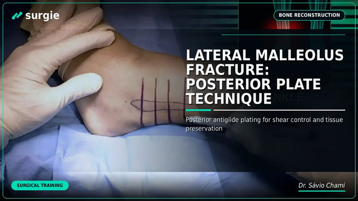 Lateral Malleolus Fracture: Posterior Plate Technique