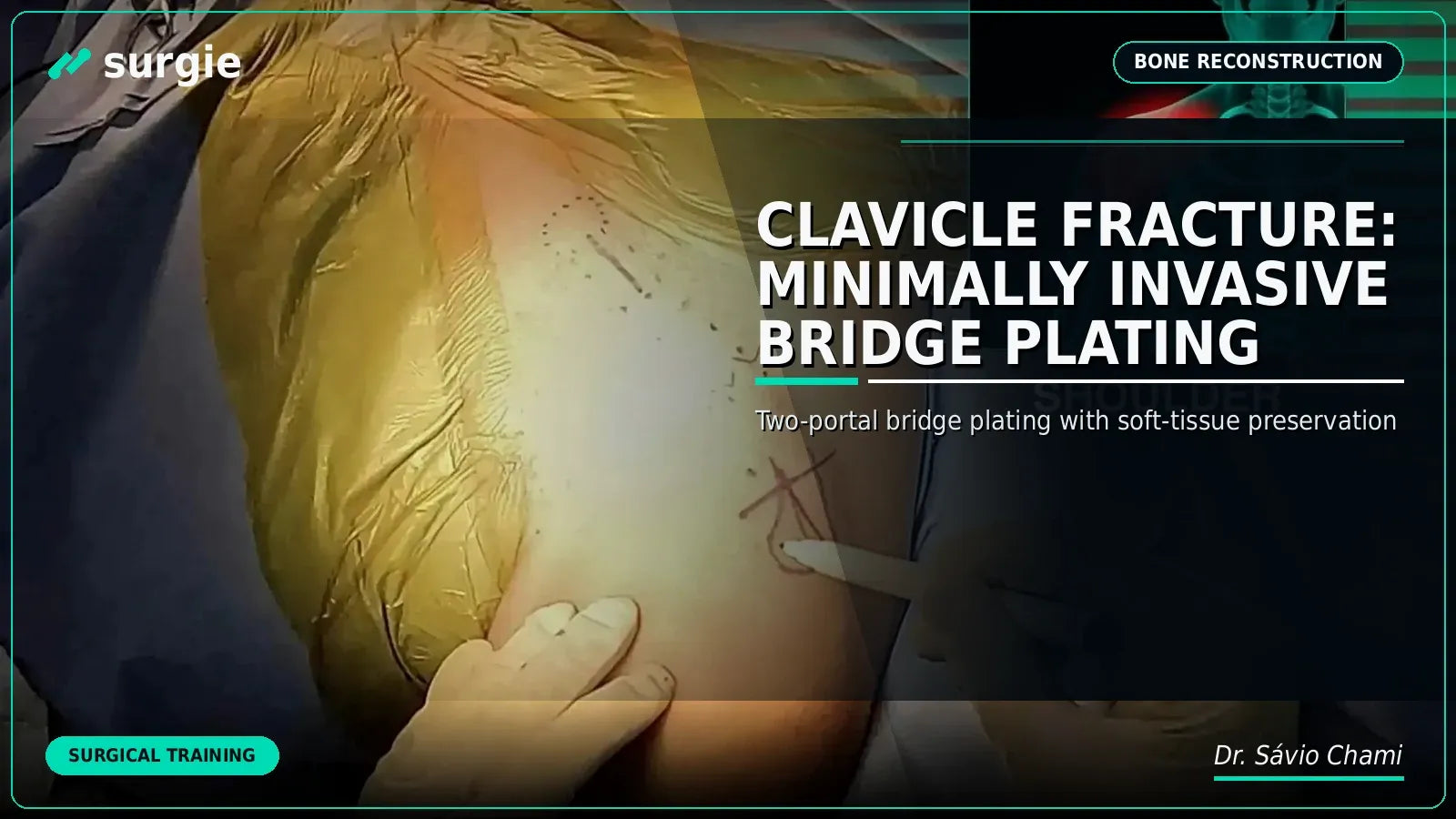Clavicle Fracture: Minimally Invasive Bridge Plating