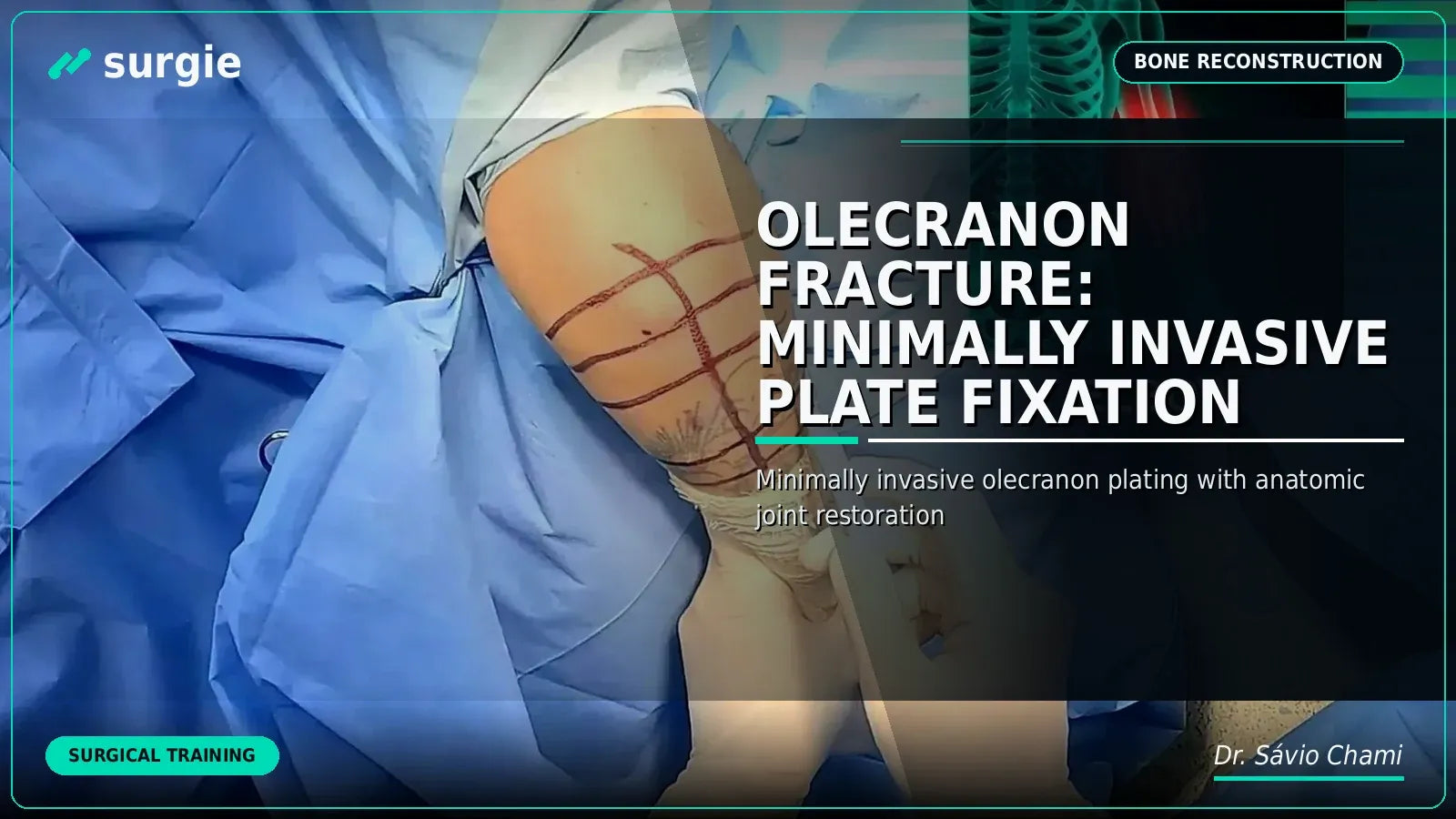 Fratura do Olécrano: Fixação com Placa Minimamente Invasiva